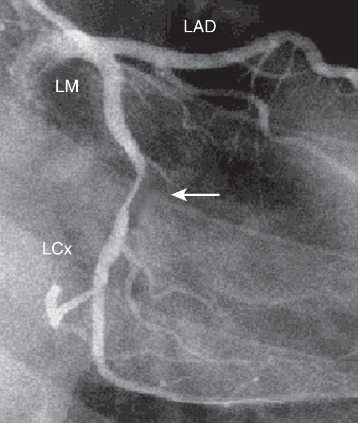Fig. 15.1, Coronary angiogram demonstrating a significant stenosis (arrow) in the left circumflex (LCx) artery. LAD, Left anterior descending artery; LM, left main coronary artery.