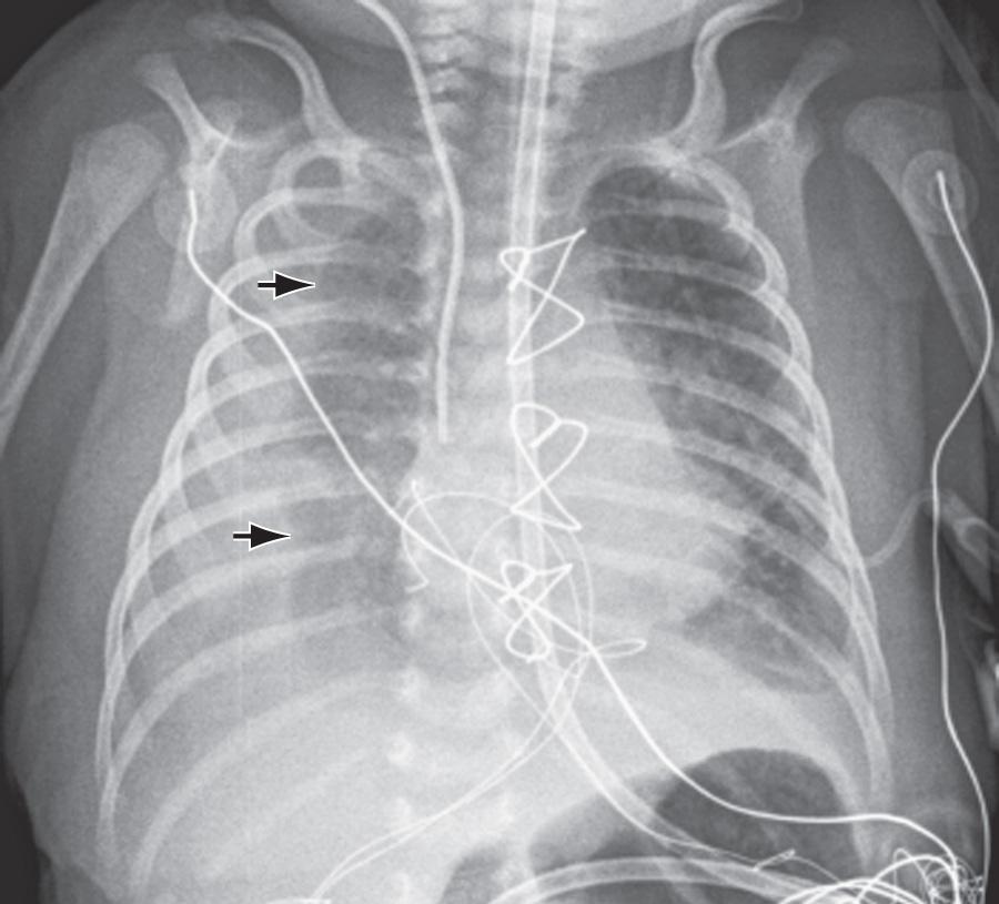 Fig. 443.1, Chylothorax (arrows) following cardiac surgery in a 2 wk old infant.