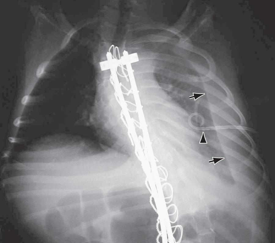 Fig. 443.2, Left chylothorax (arrows) following spinal fusion with Harrington rods. It is postulated that the thoracic duct was injured during spine surgery. The pigtail chest tube (arrowhead) needed to be retracted to better drain the effusion.