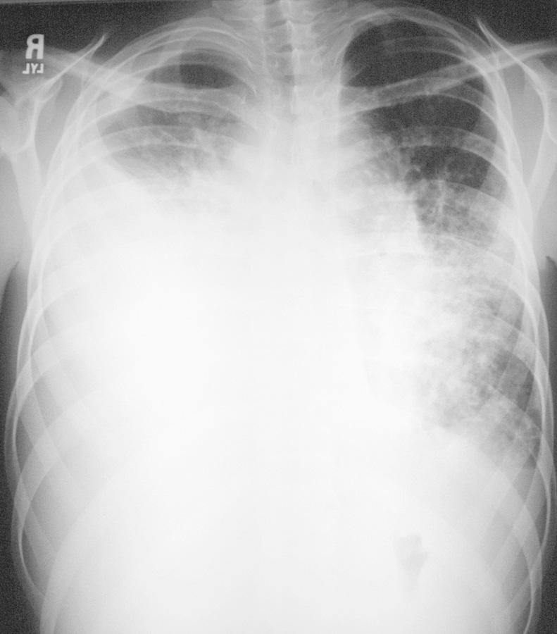 Fig. 443.3, Large right chylous effusion opacifying much of the right thorax in a teenager with pulmonary lymphangiomatosis and hemangiomatosis. Note the associated interstitial lung disease.