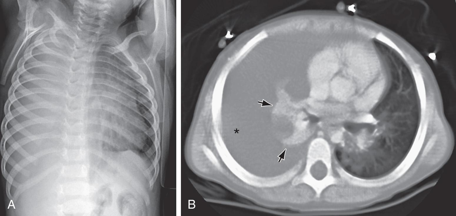 Fig. 443.4, Spontaneous chylothorax in a 4 yr old with a duplication of chromosome 6. A, Chest radiograph shows opacification of the right thorax. B, CT scan shows the chylous pleural effusion (asterisk) compressing the atelectatic right lung (arrows).