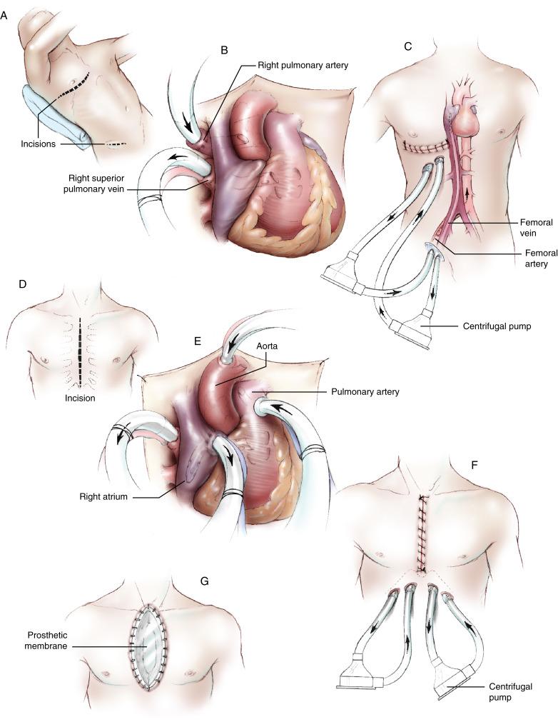Figure 3-1, A Left and right heart bypass may be instituted via a right anterior thoracotomy in patients in whom it is desirable not to violate the pericardial space. This may be important if cardiac transplantation is being considered and assisted circulation is being used as a bridge to the definitive procedure. B Thin-walled, metal-tipped, right-angled cannulae (28 or 31 F) are introduced through purse-string stitches with tourniquets. One cannula is placed through the right superior pulmonary vein to the left atrium. The other cannula is placed in the right pulmonary artery. The cannulae are brought through intercostal spaces to the skin on the right side below the primary incision. C Thin-walled percutaneous perfusion cannulae are introduced through the femoral vessels and advanced to the right atrium and the iliac artery. Right heart bypass is instituted by the uptake of blood from the right atrial percutaneous cannula and its return via centrifugal pump to the right pulmonary cannula. Left heart bypass is instituted by the uptake of blood from the left atrial cannula and its return via centrifugal pump to the iliac artery cannula. D The cannulae for left and right heart bypass are more commonly introduced through a midline sternotomy during cardiac operations. When pharmacologic and intraaortic balloon counterpulsation support of the failing circulation is insufficient to sustain life, left or right heart bypass, or both, may be necessary. E Cannulae are usually placed in the right atrium and the aorta during cardiac operations. These are utilized for left and right heart bypass. A thin-walled, metal-tipped, right-angled cannula is introduced into the left atrium via the right superior pulmonary vein through a purse-string stitch with a tourniquet. A 20-degree arterial perfusion cannula is placed in the main pulmonary artery. F Left heart bypass is established by connecting the left atrial cannula to the aortic cannula through a centrifugal pump. Right heart bypass involves connecting the right atrial cannula to the pulmonary artery cannula through a centrifugal pump. The cannulae are brought through the fascia, muscle, and skin into the left and right upper quadrants of the abdomen. Teflon felt strips are placed tightly around the cannulae in the subcutaneous tissues to seal the exit tracts. The midline incision is closed primarily. In some cases the cannulae are brought out through the wound. G The wound may be left open when the heart cannot tolerate the compression of wound closure. An Esmarch or Silastic membrane is attached to the skin edges using staples to seal the mediastinum.