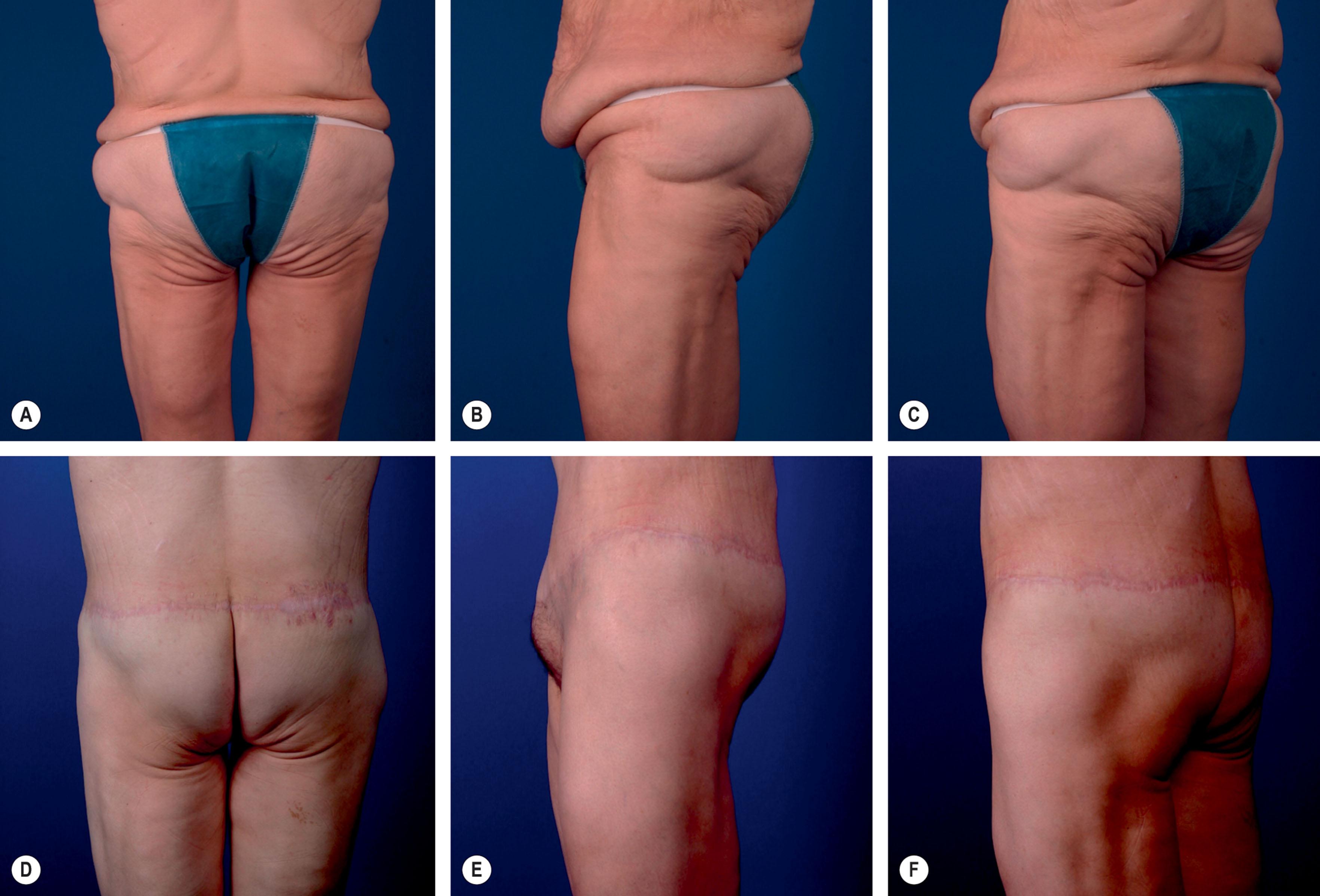 Figure 34.1, (A–F) Circumferential bodylift/excisional buttock lift and buttock flattening.