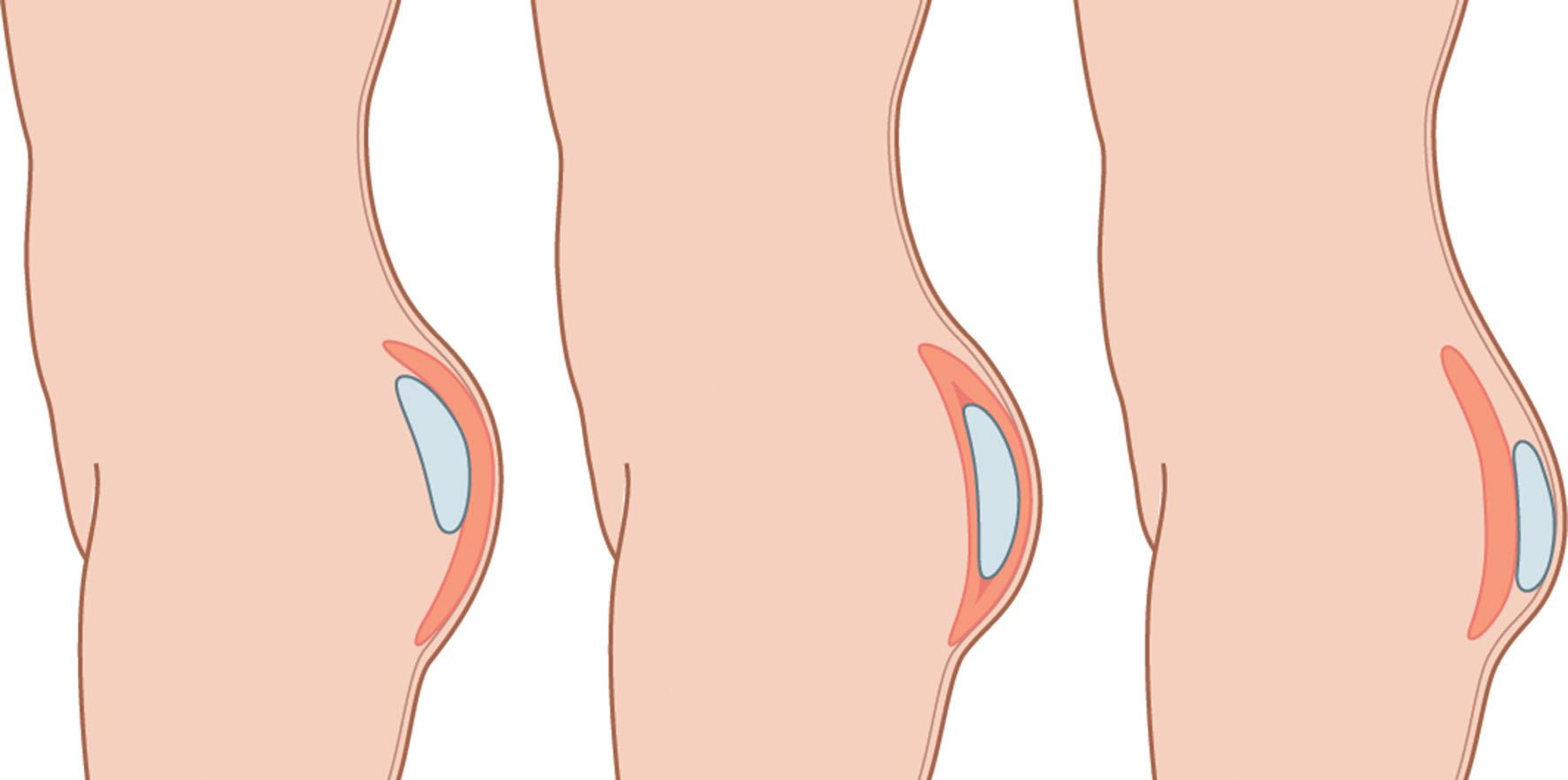 Figure 34.3, Implant position and gluteal point of maximal projection.