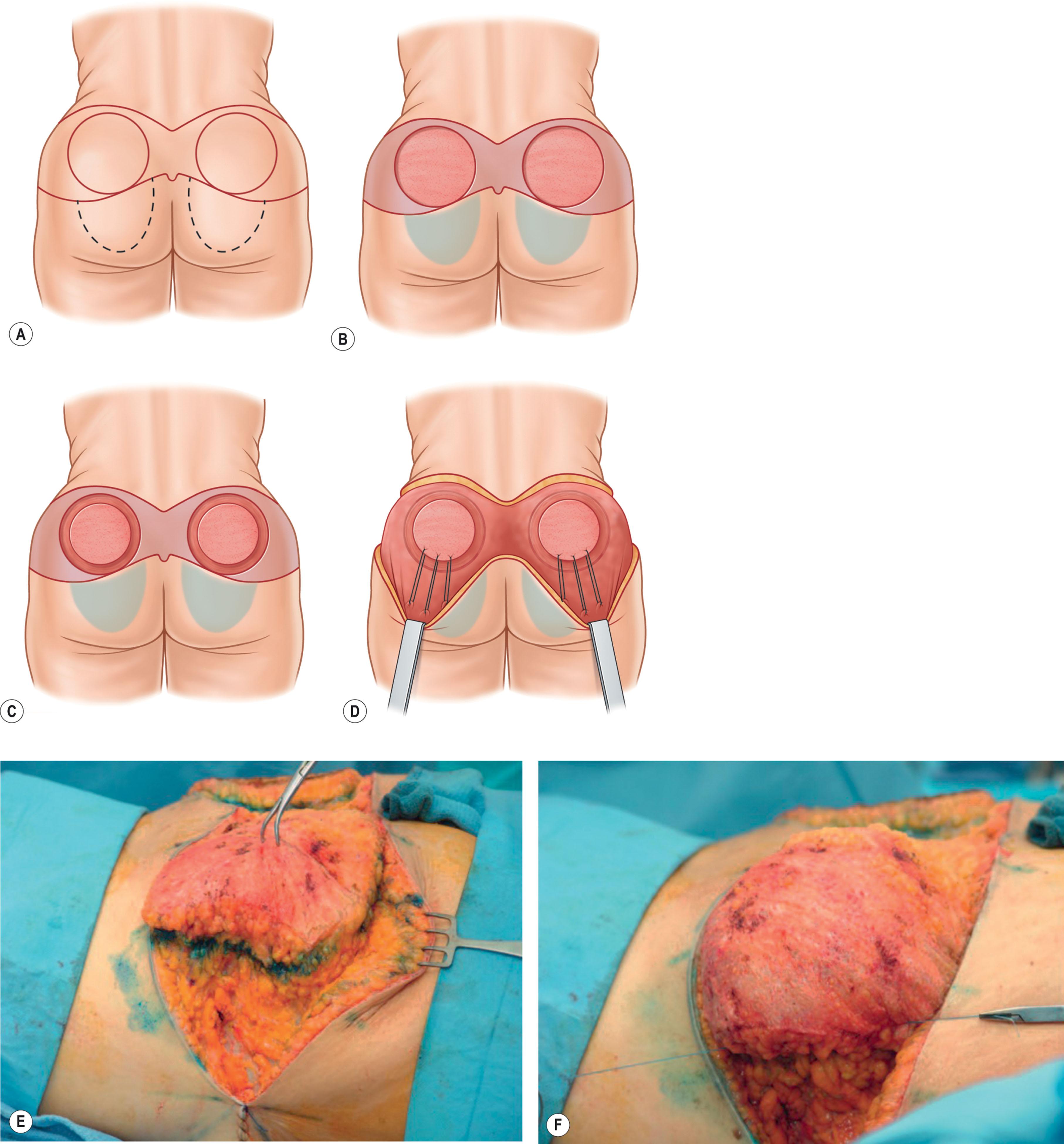 Figure 34.4, Island gluteal flaps: (A–D) Centeno – island flap; (E,F) Hunstad – purse-string flap; Figure 34.4Cont’d (G–J) Colwell–Borud – SGAP (superior gluteal artery perforator) flap.