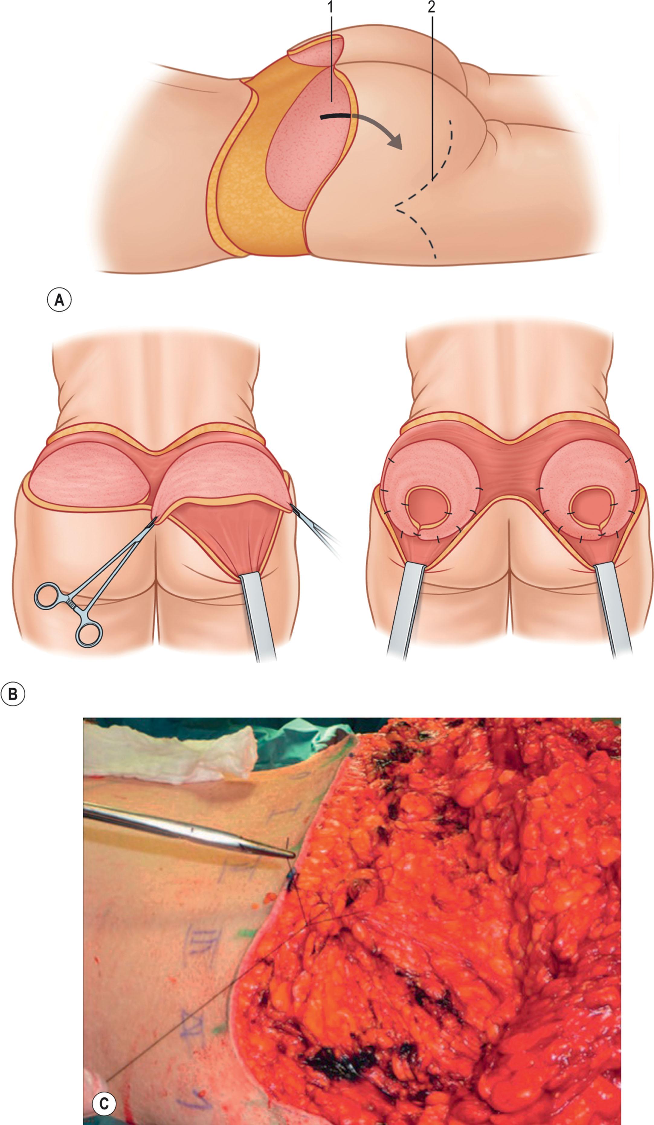 Figure 34.5, Incremental gluteal flaps: (A) Pascal; (B) Raposa–Amaral; (C) Koller.