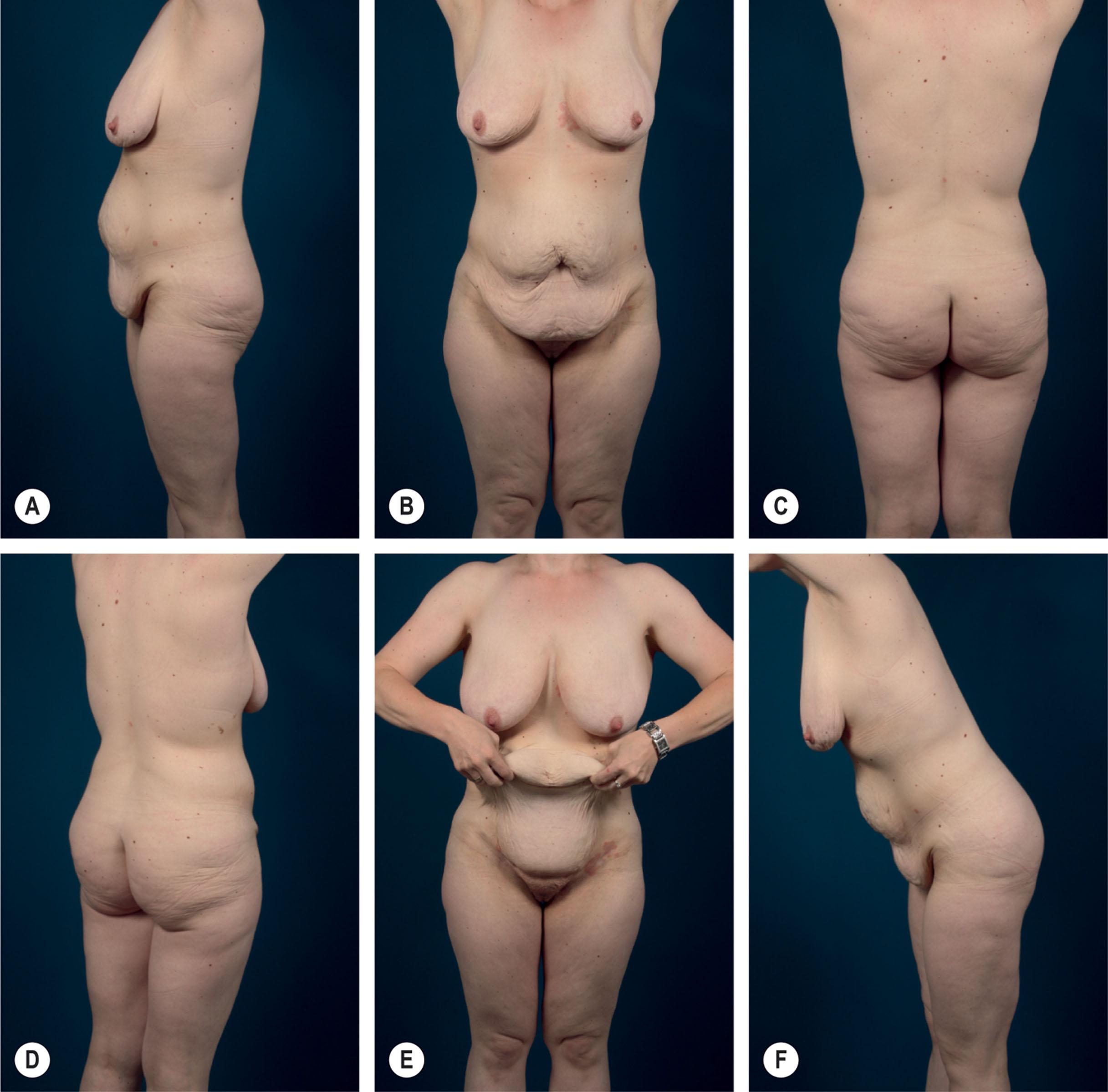 Figure 32.1, Preoperative photo series of a future bodylift patient.