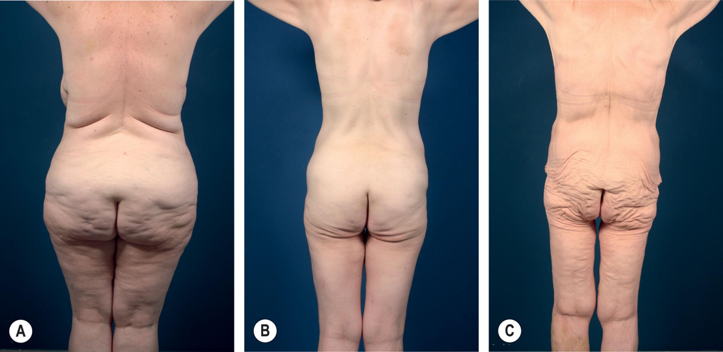 Figure 32.2, Patients with group 1 (A) , group 2 (B) , and group 3 (C) gluteal deformity showing the three different types of gluteal shape.