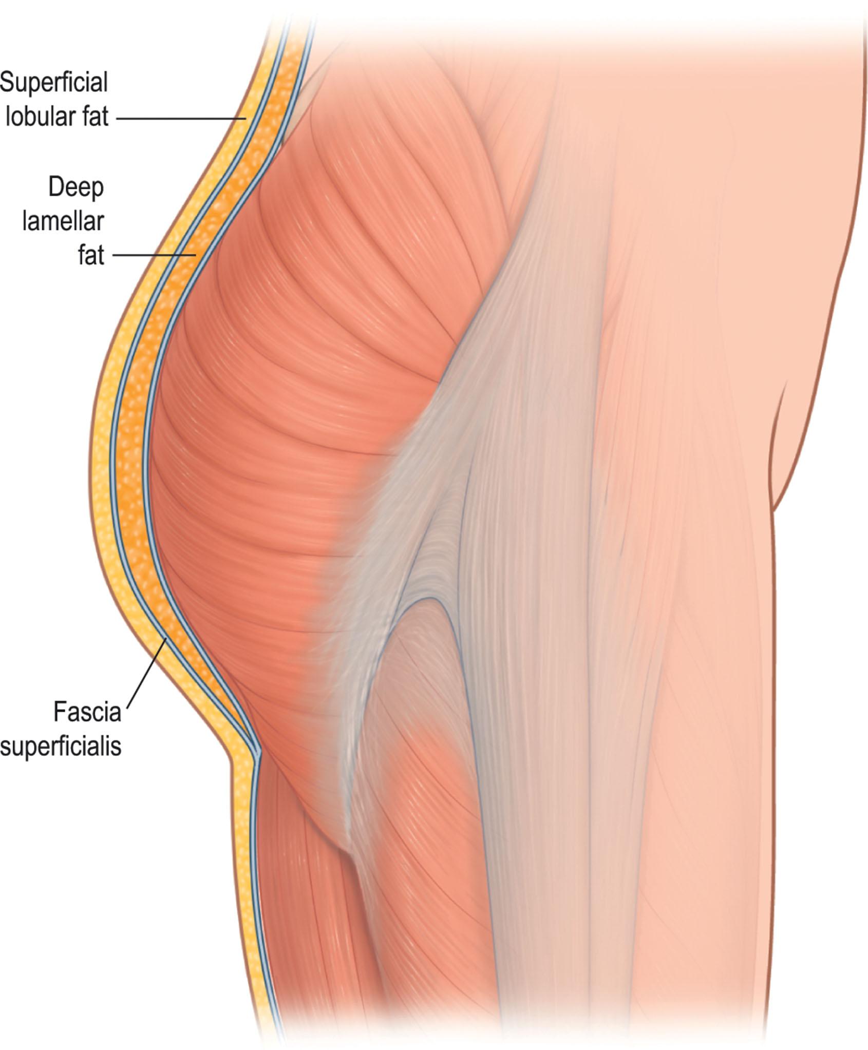 Figure 32.3, Superficial lobular fat separated by the superficial fascia from the deep lamellar fat.