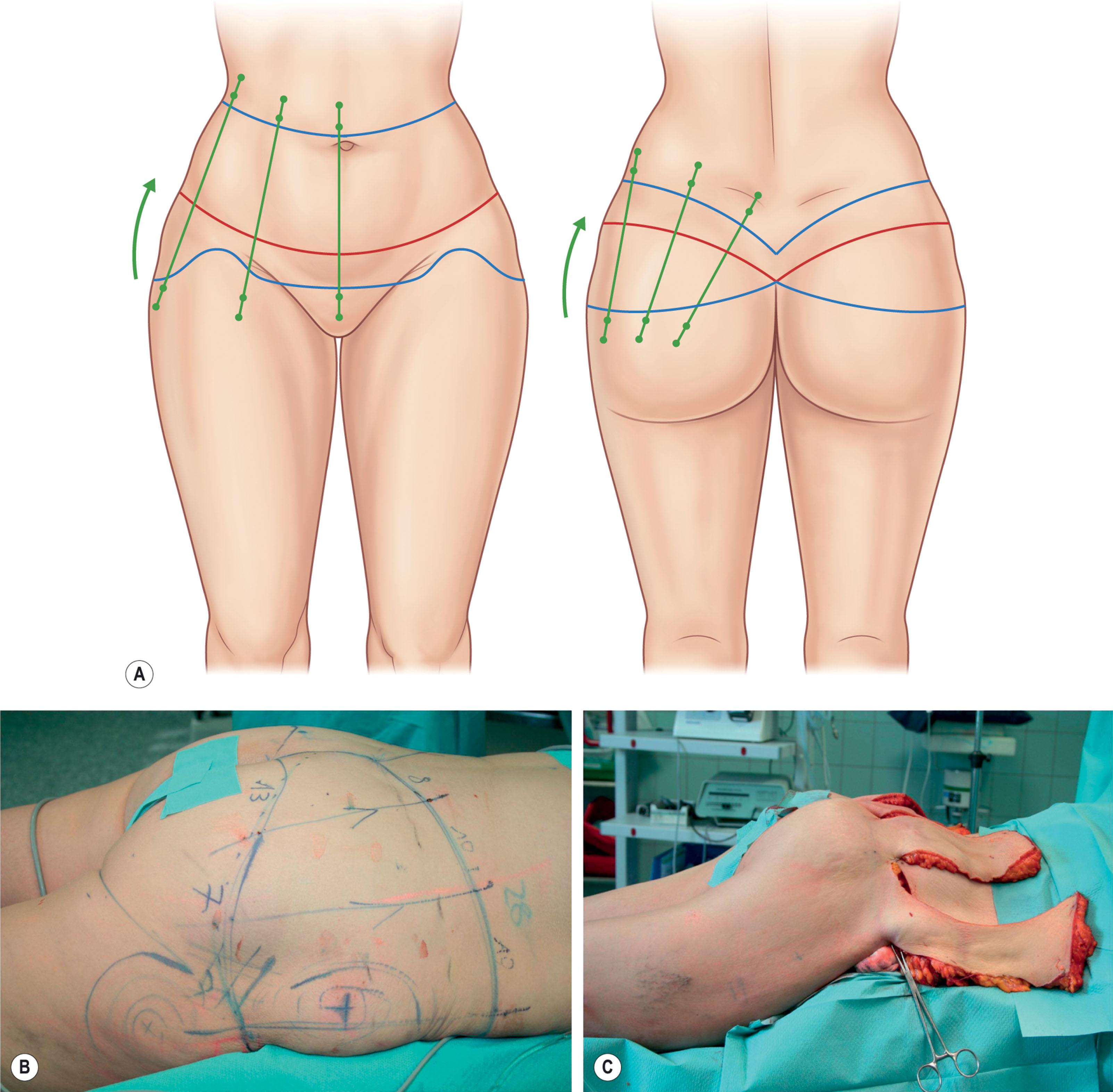 Figure 32.5, Marking of the posterior vectors is necessary to avoid a “tent-like” appearance of the back after the bodylift. Schematic (A) and intraoperative (B) demonstration of posterior vector lines. Intraoperative lateral view after incision of vectors (C) .