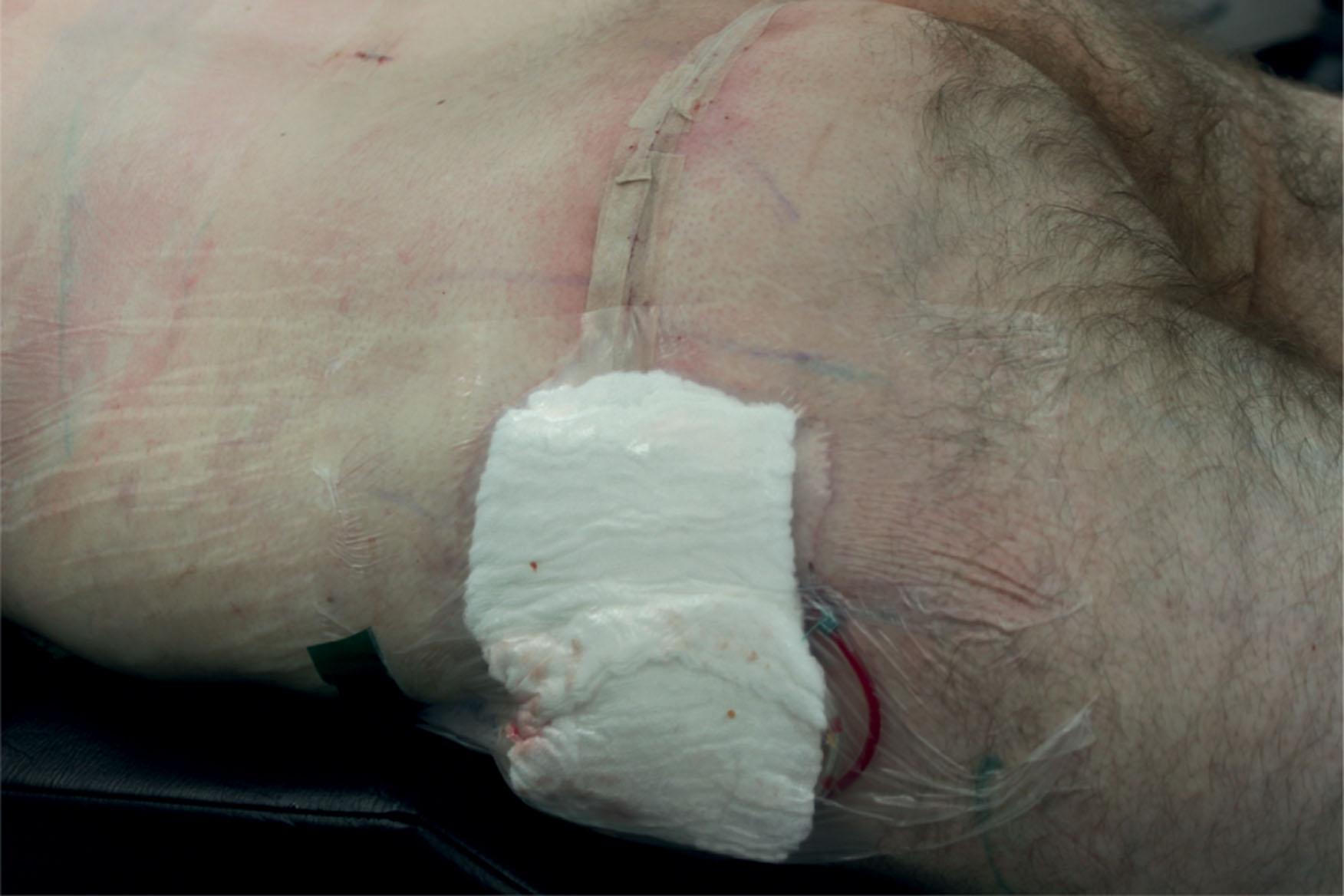 Figure 32.6, Temporary dressing of the lateral wounds with Opsite film allows an easy turnover of the patient from prone to supine position.