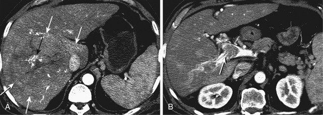 Figure 41-1, Hepatocellular carcinoma with invasion into the right portal vein. A, Axial computed tomography image during hepatic arterial phase after injection of intravenous contrast agent demonstrates a large, encapsulated mass in the right lobe of the liver (black arrow). Note the irregular arteries coursing through the lesion center (white arrows), a finding suggestive of hepatocellular carcinoma. B, On a more inferior slice, the right portal vein is expanded and contains linear areas of arterial hypervascularity (arrow). These represent tumor vessels within a malignant thrombus.