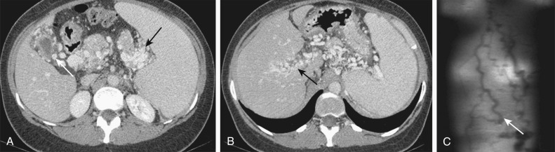 Figure 41-2, Extrahepatic manifestations of portal hypertension. A and B, Axial computed tomography contrast-enhanced images show extensive intra-abdominal varices in a patient with long-standing portal venous thrombosis. Note pericholecystic ( A, white arrow ), peripancreatic, perisplenic ( A, black arrows ), and left gastric varices as well as cavernous transformation of the right portal vein ( B, arrow ). C, Coronal single-shot fast spin echo T2-weighted image in a different patient reveals varices along the anterior abdominal wall (arrow).
