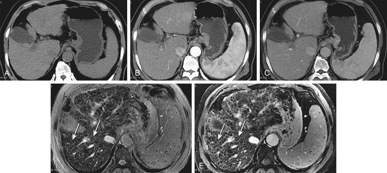 Figure 41-5, Regenerative nodules (RNs). Axial unenhanced (A) and contrast-enhanced (B) arterial and portal venous phase (C) CT images. A to C, The liver parenchyma shows minimal heterogeneity, and discrete RNs are not confidently characterized. D, At the same level as the CT images, on axial two-dimensional spoiled gradient echo magnetic resonance (MR) image obtained at 3.0 T with echo time of 5.8 ms after superparamagnetic iron oxide (SPIO) administration, the RNs are visible as sharply demarcated hypointense nodules (arrows) owing to phagocytic uptake of SPIO, which causes T2* shortening. E, On double-contrast–enhanced MR image after gadolinium administration, fibrotic reticulations display an increase in signal intensity owing to the extracellular accumulation of the low molecular weight contrast agent. Enhancement of fibrotic tissue further increases visibility of RNs (arrows). Note that this image shows innumerable RNs carpeting the liver. The two representative RNs as labeled for illustrative purposes are examples of SPIO-enhanced and double-contrast–enhanced MRI.