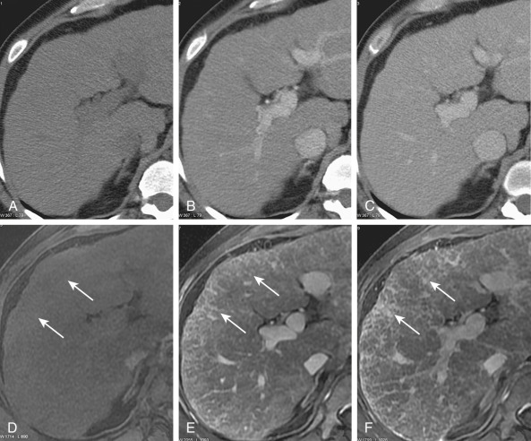 Figure 41-6, Dynamic enhancement of fibrotic tissue in the cirrhotic liver. Dynamic contrast-enhanced (A), unenhanced portal venous phase (B) and delayed phase (C) computed tomography (CT) images show the nodular liver surface diagnostic of cirrhosis. The liver parenchyma is homogeneous, with neither fibrotic reticulations nor RNs clearly identified. Dynamic gadolinium-enhanced axial gradient recalled unenhanced (D), portal venous (E), and delayed (F) phase magnetic resonance (MR) images obtained at the same level as the CT images show progressive enhancement of the fibrotic reticulations as a result of accumulation of the low molecular weight gadolinium. Dynamic MR images depict the enhancement of the fibrotic septa (arrows) with higher clarity than CT.