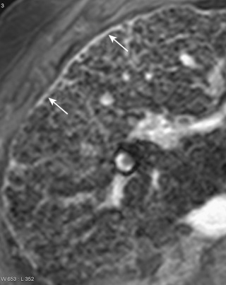 Figure 41-7, Hepatic capsular thickening. On this axial double-contrast–enhanced magnetic resonance image, the hepatic capsule can be seen retaining gadolinium and has high signal intensity similar to the fibrotic reticulations distributed throughout the liver. As illustrated in this case, the fibrotic thickening of the liver capsule (arrows) is a frequent manifestation of cirrhosis but it is not always observed on imaging.