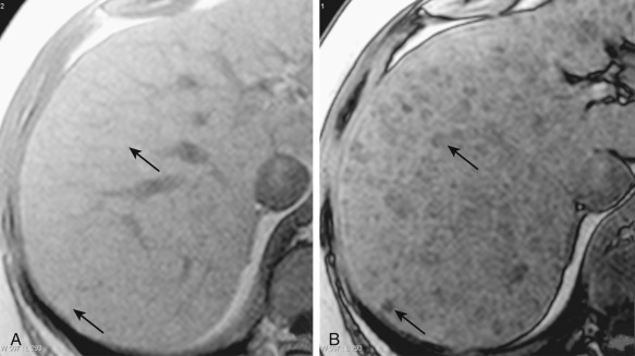 Figure 41-9, Fatty regenerative nodules (RNs). On axial unenhanced magnetic resonance in-phase (A) and out-of-phase (B) images, RNs can be appreciated (arrows). The RNs lose signal, as evidenced by the decrease in signal intensity on out-of-phase images, indicating the presence of intralesional fat. Innumerable nodules are present in the images.