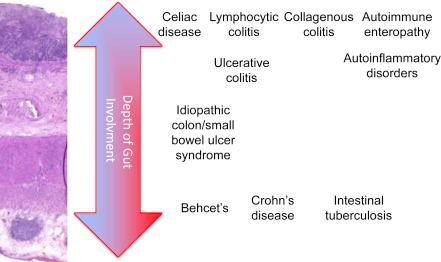 Figure 2.1, Depth of inflammation in various forms of immune-mediated chronic inflammatory bowel disease.