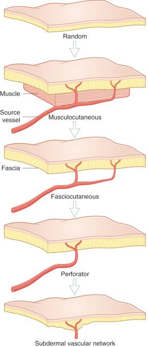 Figure 2.1, The evolution of flaps has reflected a progression to better ensure the adequacy of their intrinsic circulation, beginning with the least reliable, nourished only via the subdermal plexus, and ultimately coming back again full circle to the subdermal vascular network “supercharged” by retained perforators.