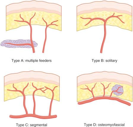 Figure 2.2, The subtypes of fasciocutaneous flaps in Cormack and Lamberty's classification schema differ according to the means of vascularization of the “fascial plexus.”