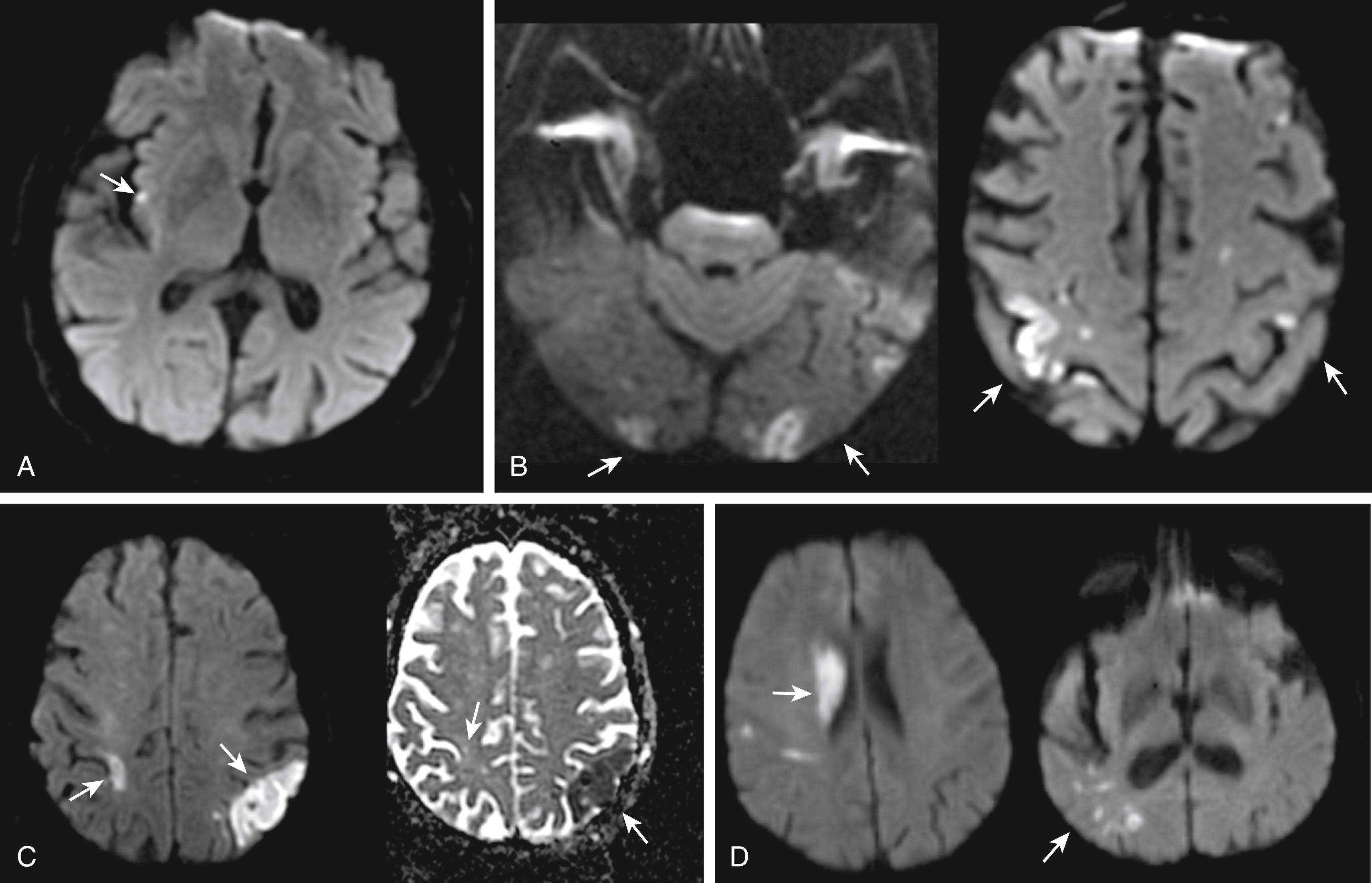 Fig. 20.2, Imaging characteristics of unstable etiology: (A) isolated cortical infarct (arrow) ; (B) simultaneous acute infarcts (arrows) in different circulations; (C) infarcts (arrows) of different ages (diffusion-weighted imaging and the corresponding apparent diffusion coefficient map on the right); (D) multiple scattered infarcts (arrows) .