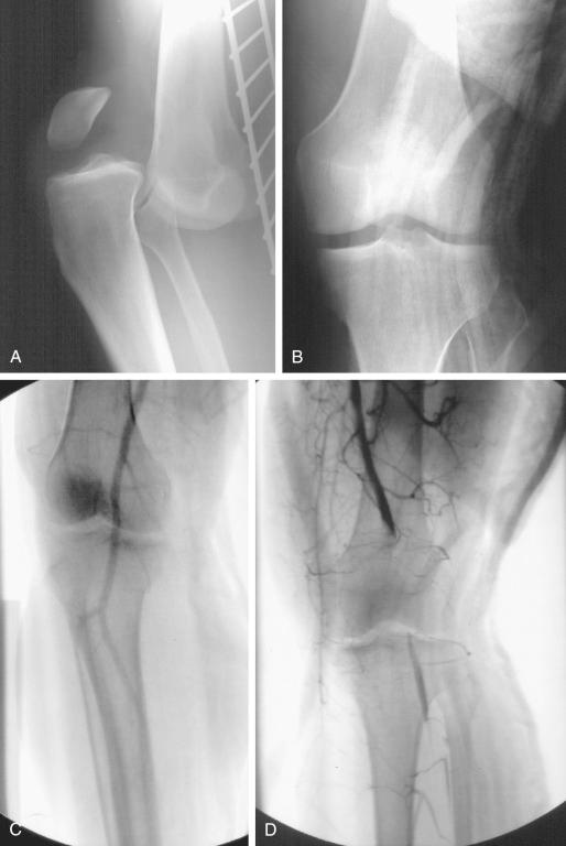 FIG 21-1, Bilateral knee injuries, both classified as dislocation, presenting in the same patient. A, A lateral radiograph of the right knee demonstrates an anterior dislocation. On examination, the patient was noted to have sustained an anterior cruciate ligament/posterior cruciate ligament/medial collateral ligament (ACL/PCL/MCL) injury (knee dislocation [KD] III-M). B, An anteroposterior view of the left knee on initial presentation shows the knee is reduced. On physical examination, the injury pattern involved the ACL/PCL/fibular collateral ligament (FCL) (KD III-L-C). C, An arteriogram of the right knee reveals good flow through the popliteal artery. D, An arteriogram of the reduced left knee demonstrates complete occlusion of the left popliteal artery and hence required revascularization.