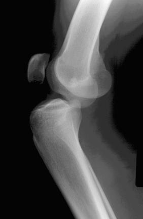 FIG 21-2, This patient presented with a posterior cruciate ligament–intact knee dislocation. Note how the tibia is perched anterior on the distal femur. This type of injury would be classified as KD I according to the anatomic classification system, to be discussed later.