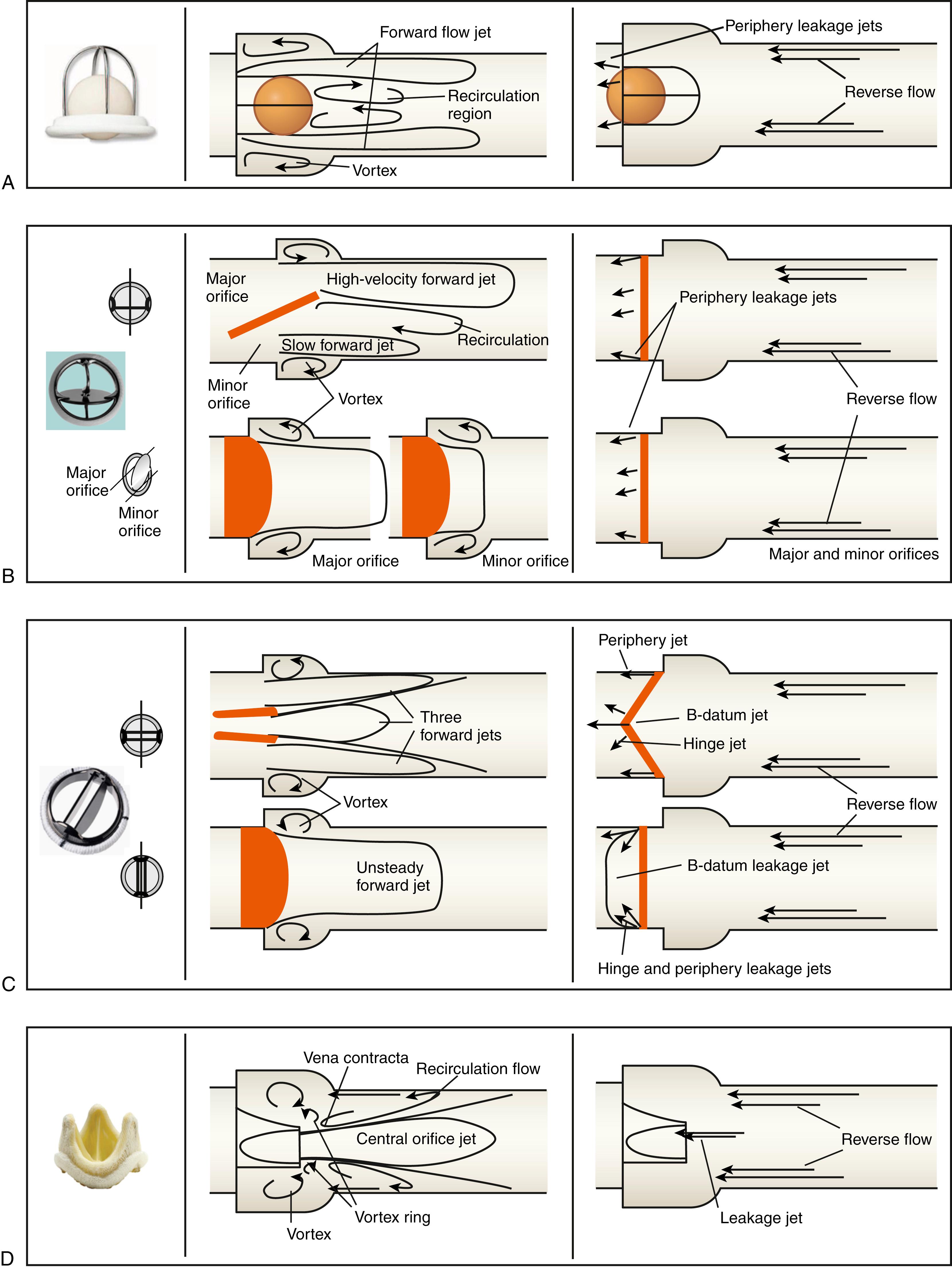 Figure 109.2, Flow patterns downstream of selected prosthetic valve designs during the forward flow phase (left) and the leakage flow phase (right). A, Ball-cage valve. B, Monoleaflet valve. C, Bileaflet valve. D, Stented bioprosthetic valve.