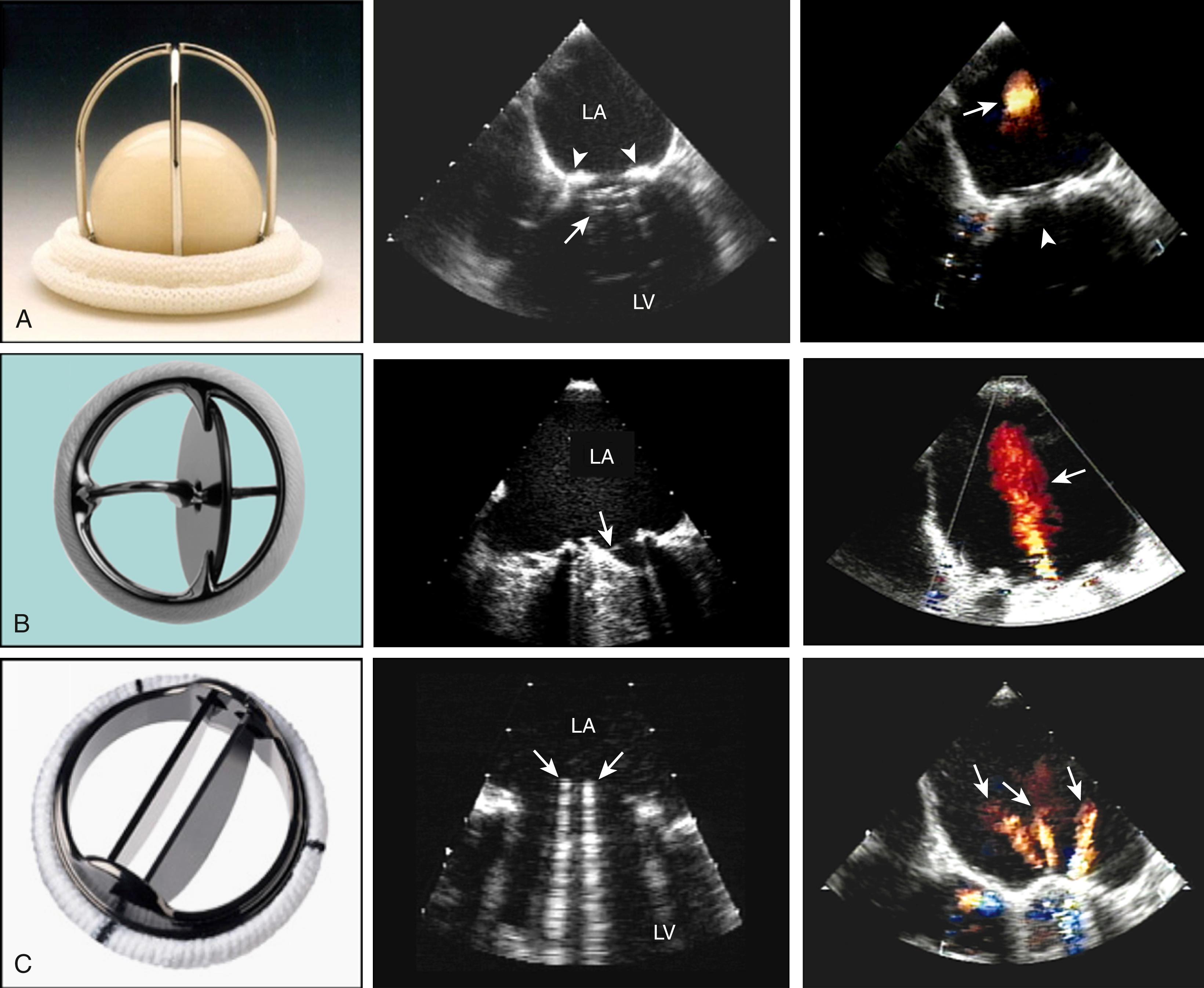 Figure 109.3, Examples of caged-ball ( A ), monoleaflet ( B ), and bileaflet ( C ) mechanical valves and stented ( D ), stentless ( E ), and transcatheter ( F ) bioprosthetic valves and their transesophageal echocardiographic characteristics taken in the mitral ( A, B, C, and D ) or aortic ( E and F ) positions in diastole (middle) and in systole (right). For mechanical valves ( A, B, and C ), the arrows in diastole point to the occluder mechanism of the valve, and in systole to the characteristic physiologic regurgitation. In the transcatheter valve ( F ), the arrow shows a mild paravalvular aortic regurgitation. LA, Left atrium; LV, left ventricle.