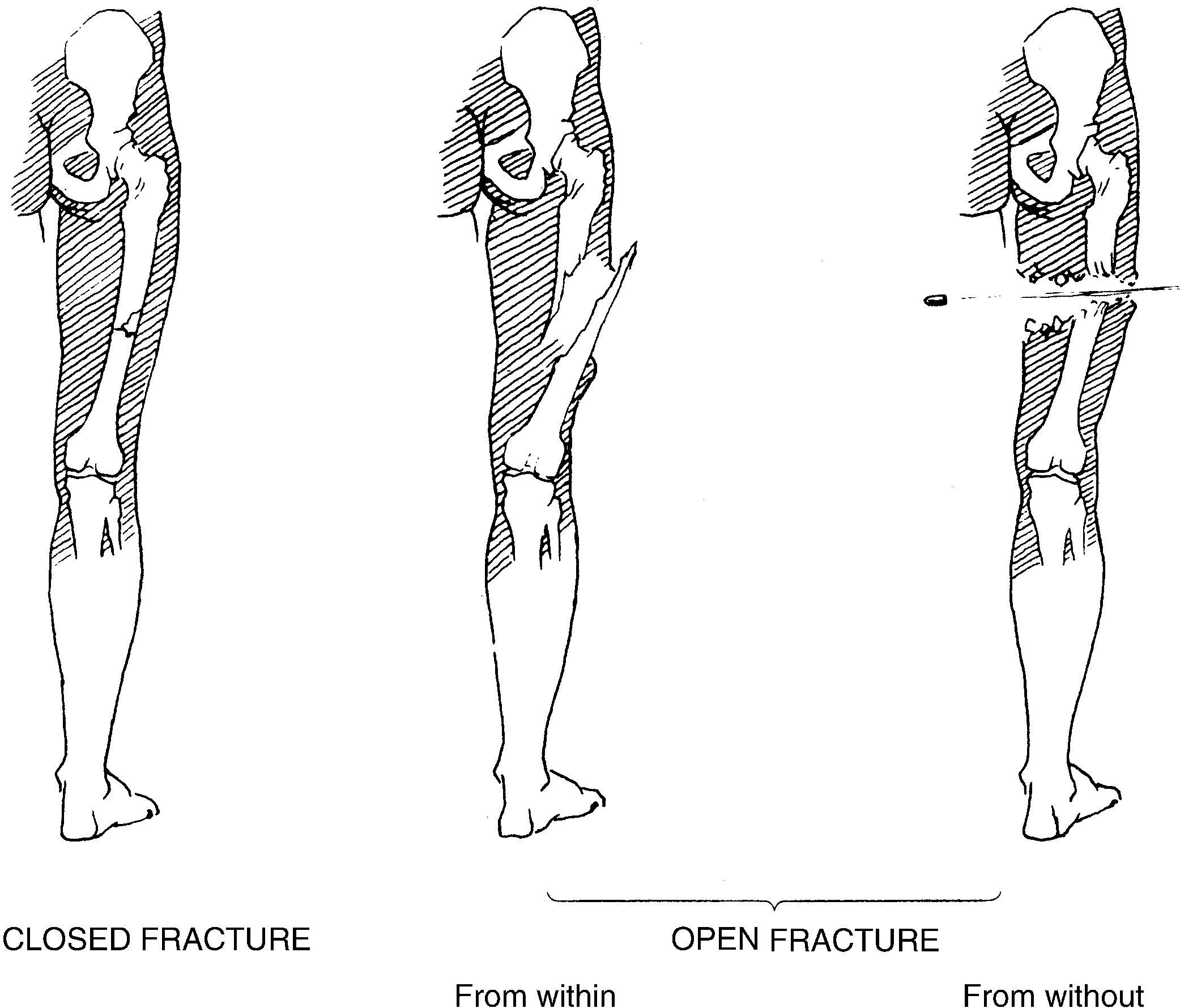 Fig. 1-1Closed versus open fracture. (From Schneider FR: Handbook for the orthopaedic assistant , ed 2, St Louis, 1976, The CV Mosby Co.)