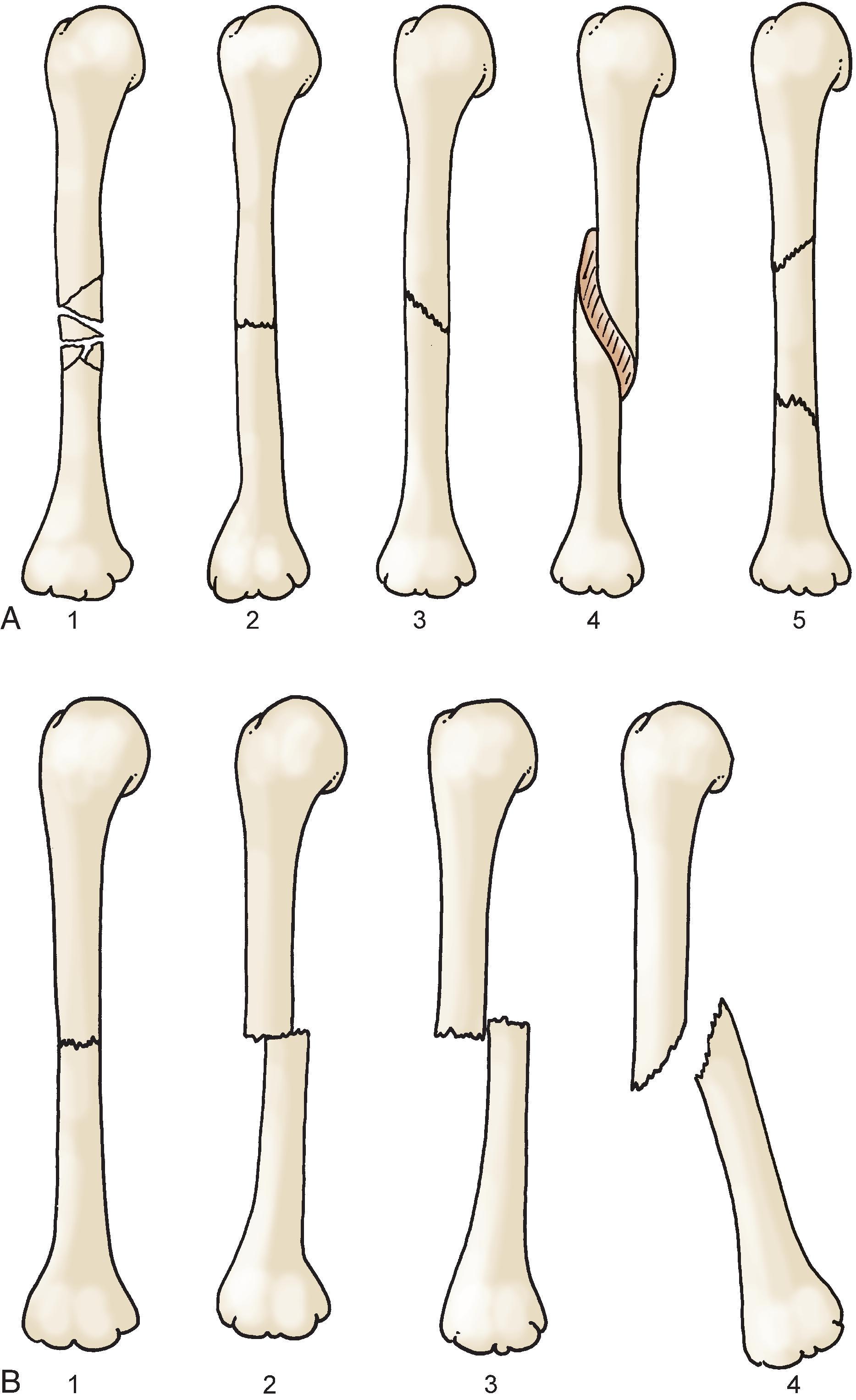 Fig. 1-2 A, Midshaft fractures of the humerus. 1, Comminuted. 2, Transverse, undisplaced. 3, Oblique, undisplaced. 4, Spiral. 5, Segmental. B, Apposition and alignment of midshaft fractures of the humerus, anteroposterior view. 1, Perfect end-to-end apposition, perfect alignment. 2, 50% end-to-end apposition, perfect alignment. 3, Side-to-side (bayonet) apposition, slight shortening, perfect alignment. 4, No apposition, approximately 30-degree angulation. (From Mercier LR: Practical orthopaedics, ed 5, St Louis, 2000, Mosby.)