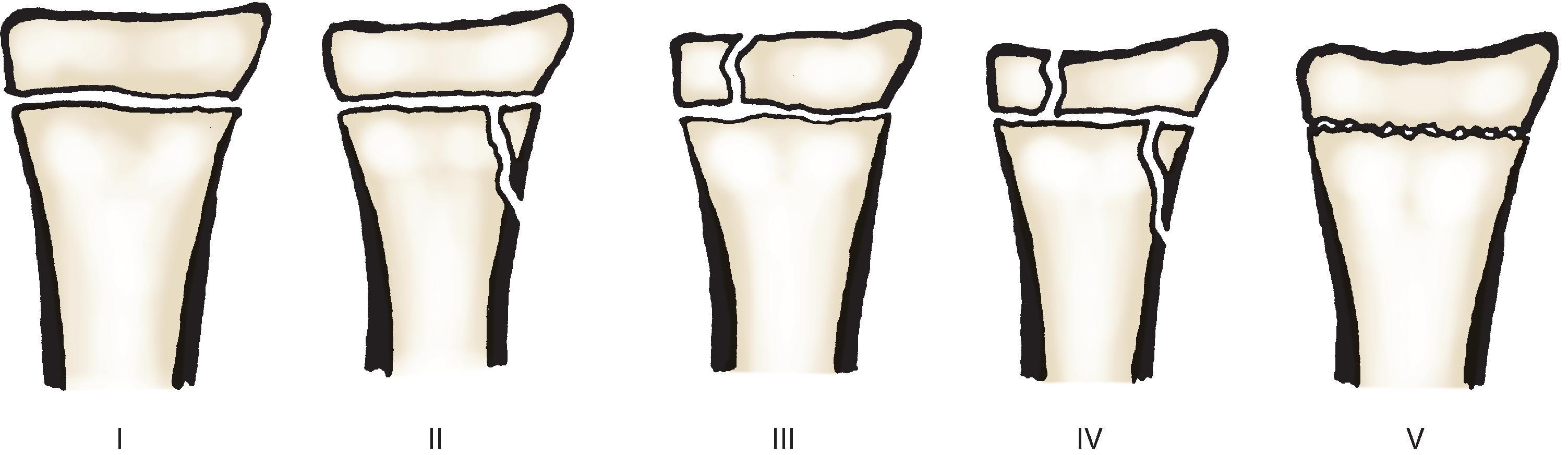 Fig. 1-3Epiphyseal fracture types classified by the Salter method.