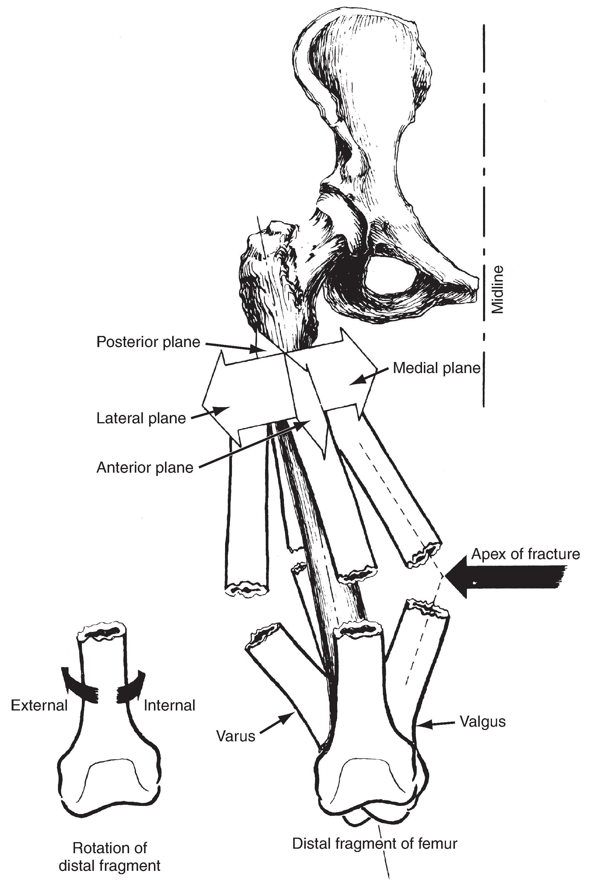 Fig. 1-4Description of fracture deformity. (From Schneider FR: Handbook for the orthopaedic assistant , ed 2, St Louis, 1976, The CV Mosby Co.)