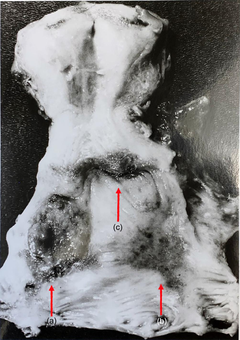 Fig. 16.1, Pathologic specimen showing an adenocarcinoma on the proximal vagina (a) adjacent to the cervix. There are nearby regions of adenosis present on the vagina (b) and cervix (c) as well. 2