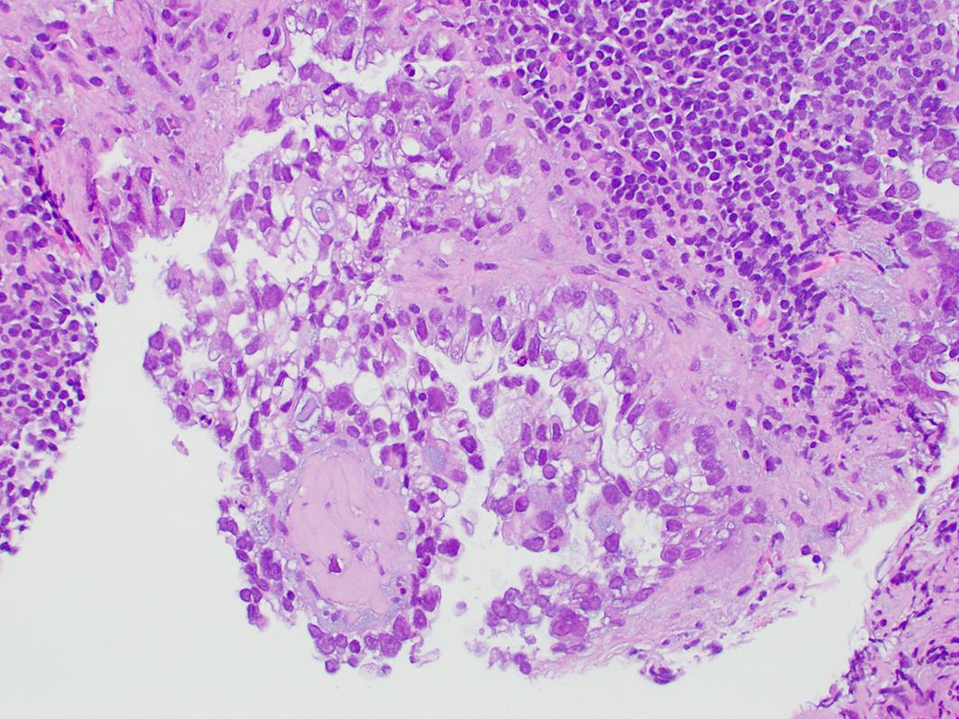 Fig. 16.2, Clear cell carcinoma with “hobnail” cells of bulbous nuclei protruding to the surface.