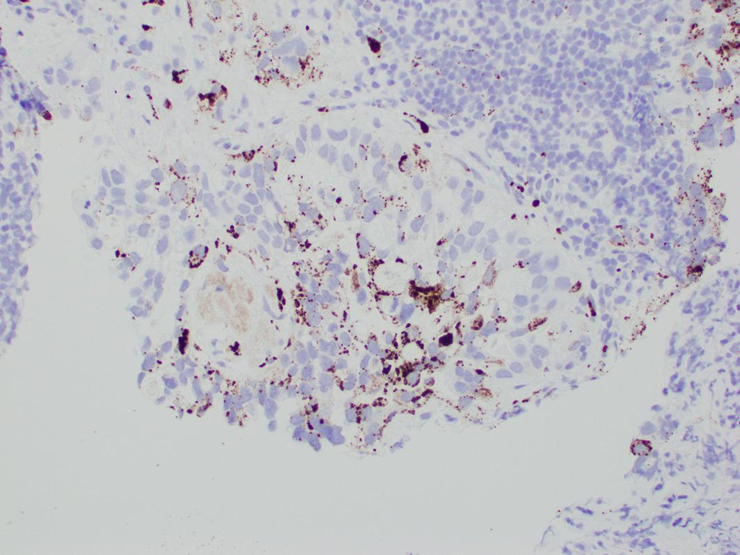 Fig. 16.3, Clear cell carcinoma with immunohistochemical positivity for Napsin.