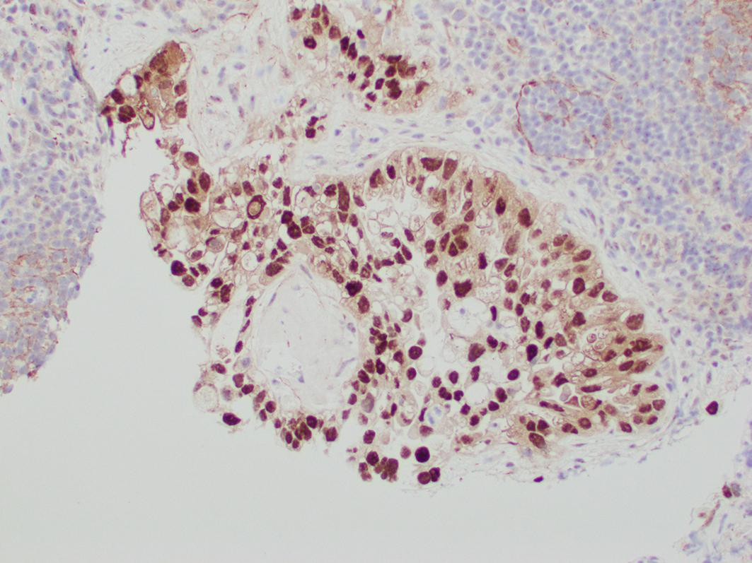 Fig. 16.4, Clear cell carcinoma with immunohistochemical positivity for HNF1-b.