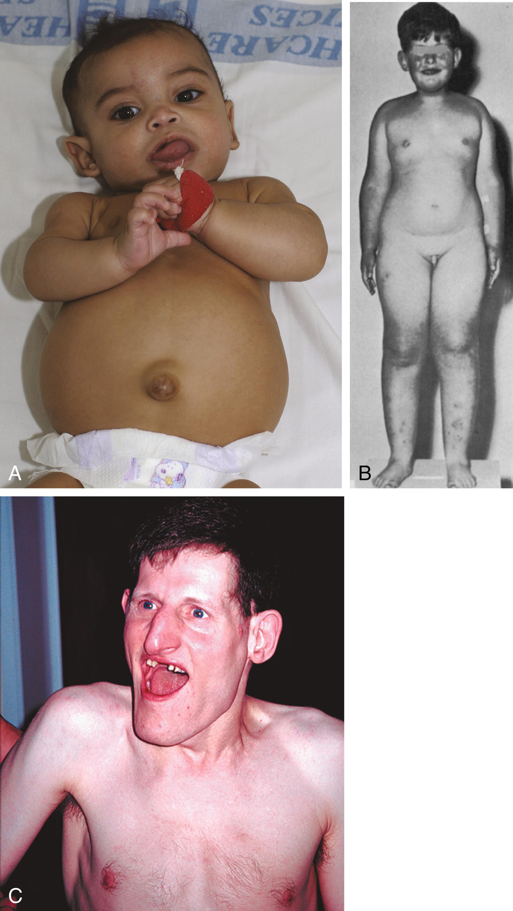 Fig. 4.7, Syndromes associated with parental imprinting.