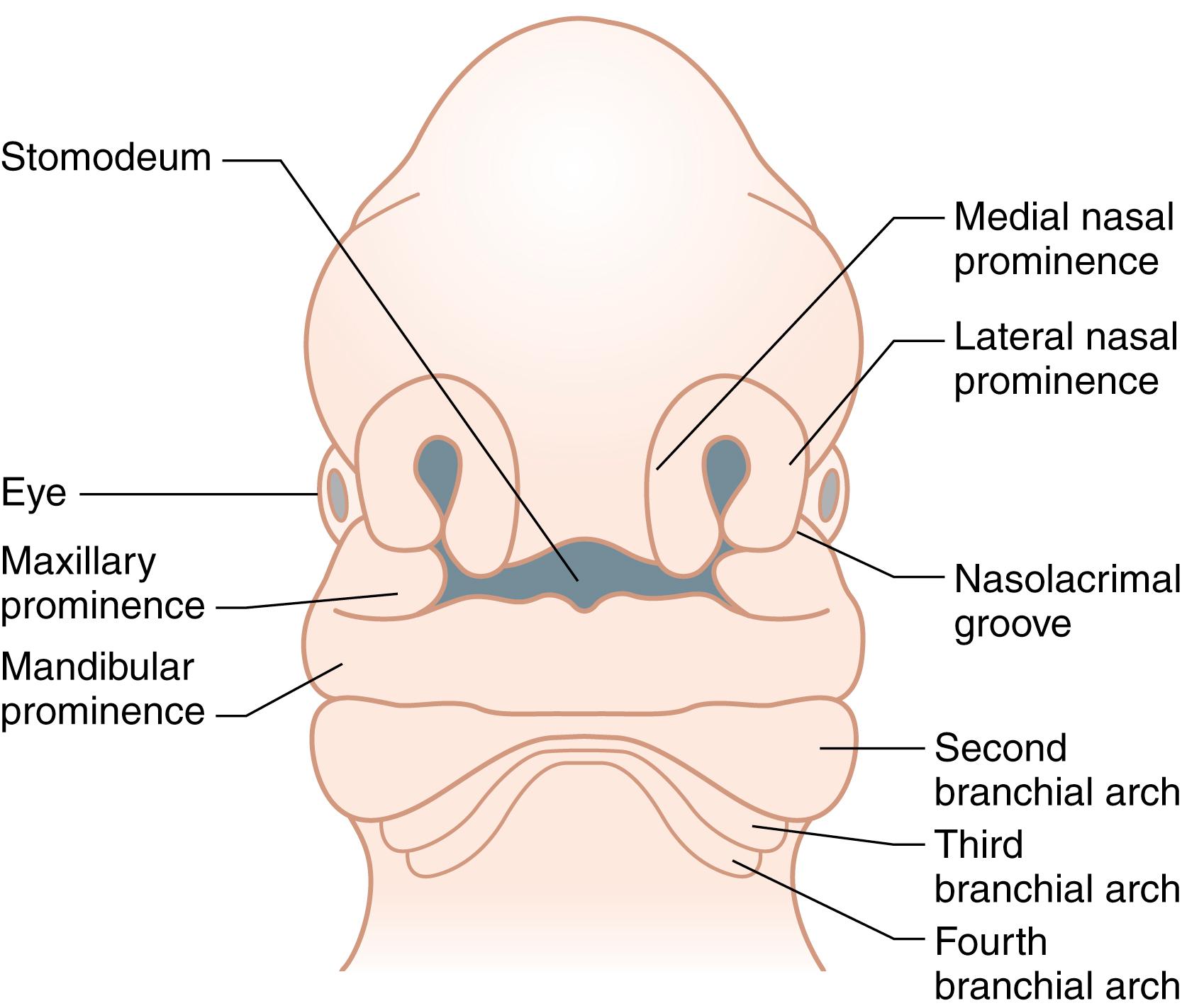 Fig. 16.1, Embryology of the primary palate. Failure of fusion of the medial nasal prominence and the ipsilateral maxillary prominence results in a unilateral cleft lip.