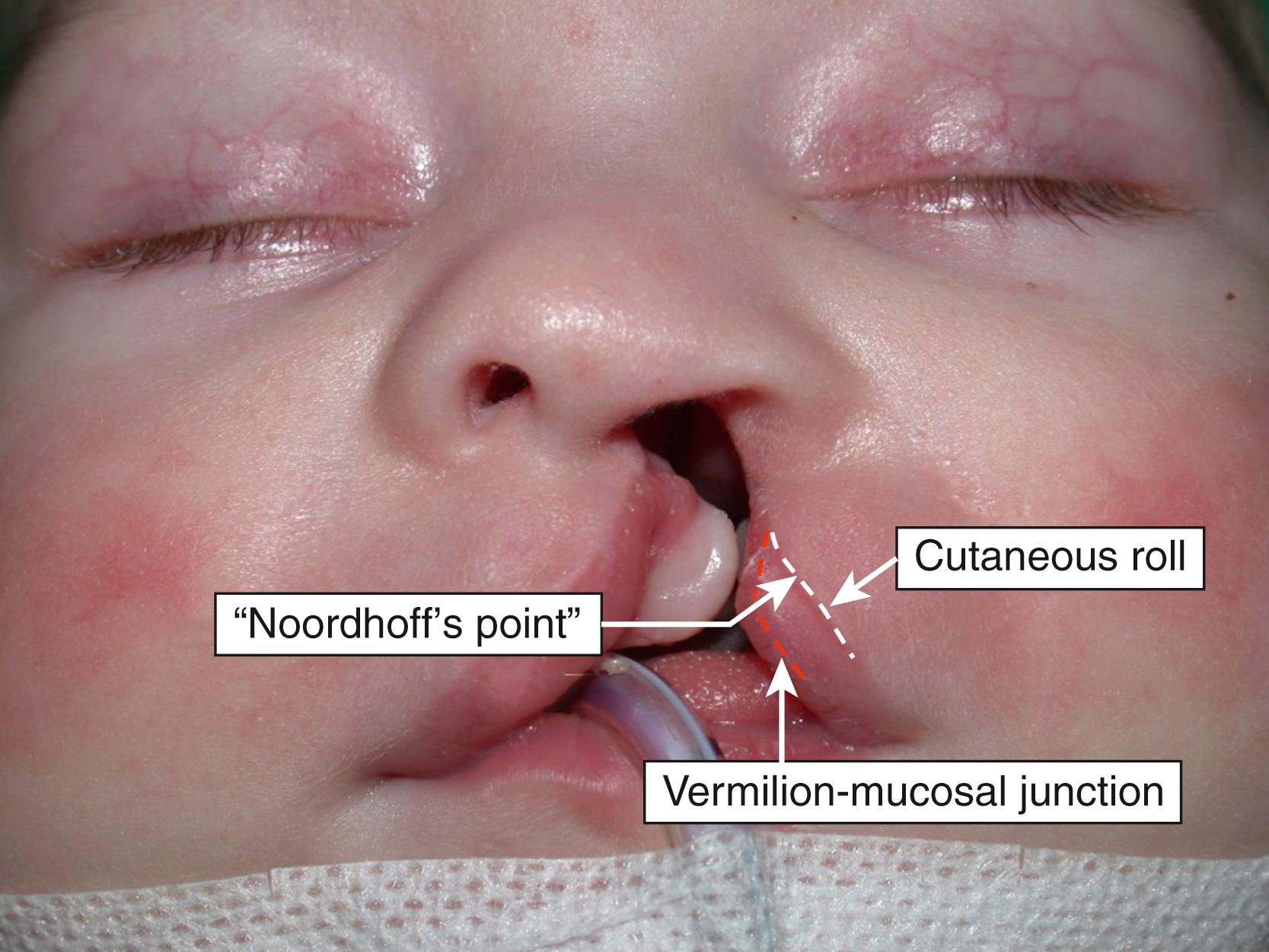 Fig. 16.2, Infant with a complete left cleft lip and palate. The cardinal position of “Noordhoff’s point” is marked.