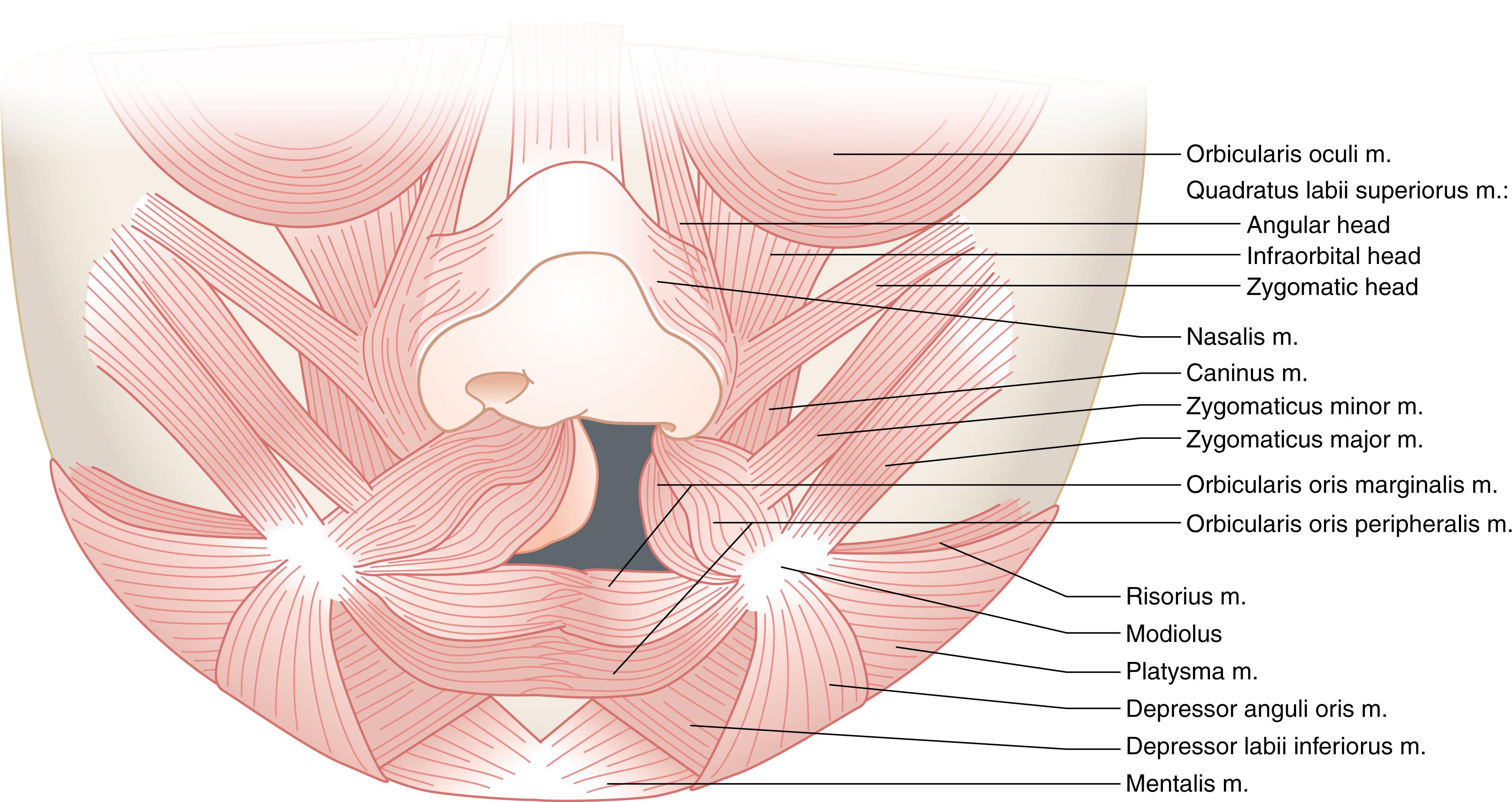 Fig. 16.3, Orientation of the orbicularis oris fibers in a patient with a complete left unilateral cleft lip.