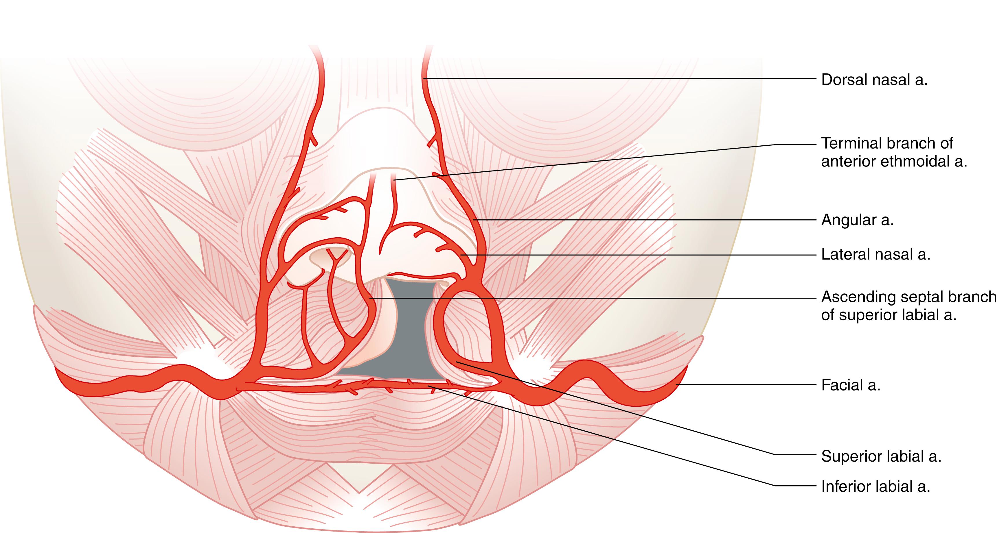 Fig. 16.4, Blood supply to the nasolabial complex in a patient with a complete left unilateral cleft lip.