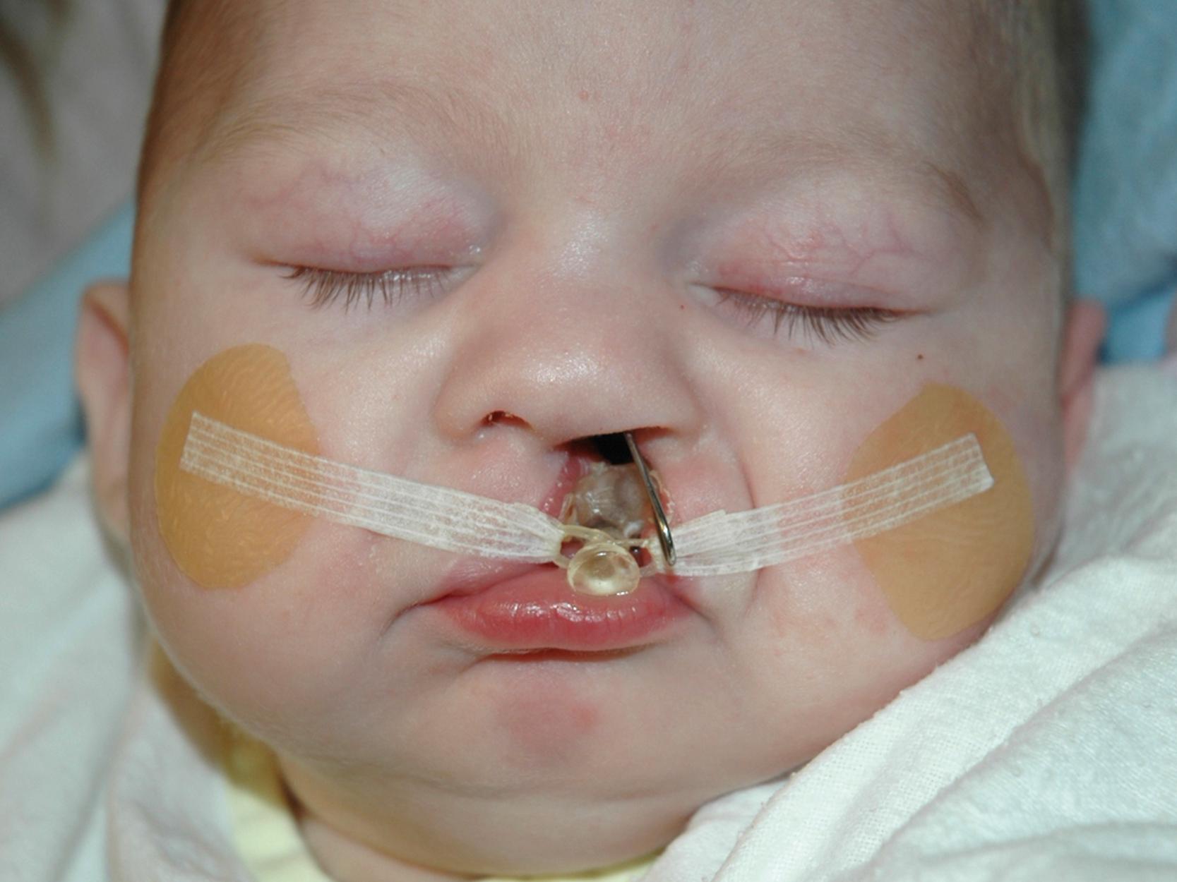 Fig. 16.5, Nasoalveolar moulding plate in situ with left nasal stent evident in a 3-month old infant with a complete unilateral cleft lip and palate.