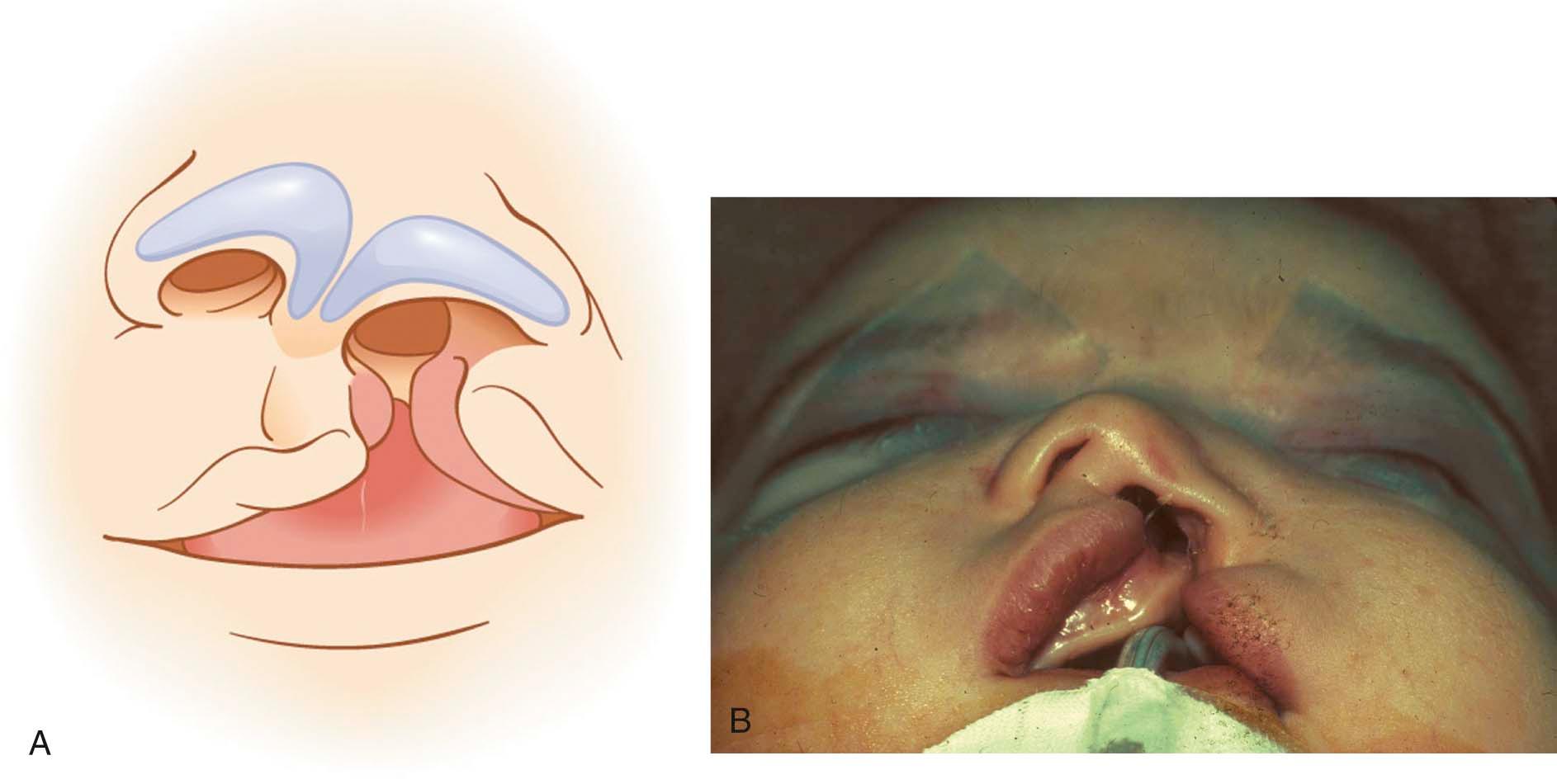 Figure 34-2, A, B, Schematic diagram and intraoperative photograph of a left complete cleft nasal deformity. On the cleft side, the medial crus is shorter and the lateral crus longer than the noncleft side counterpart.