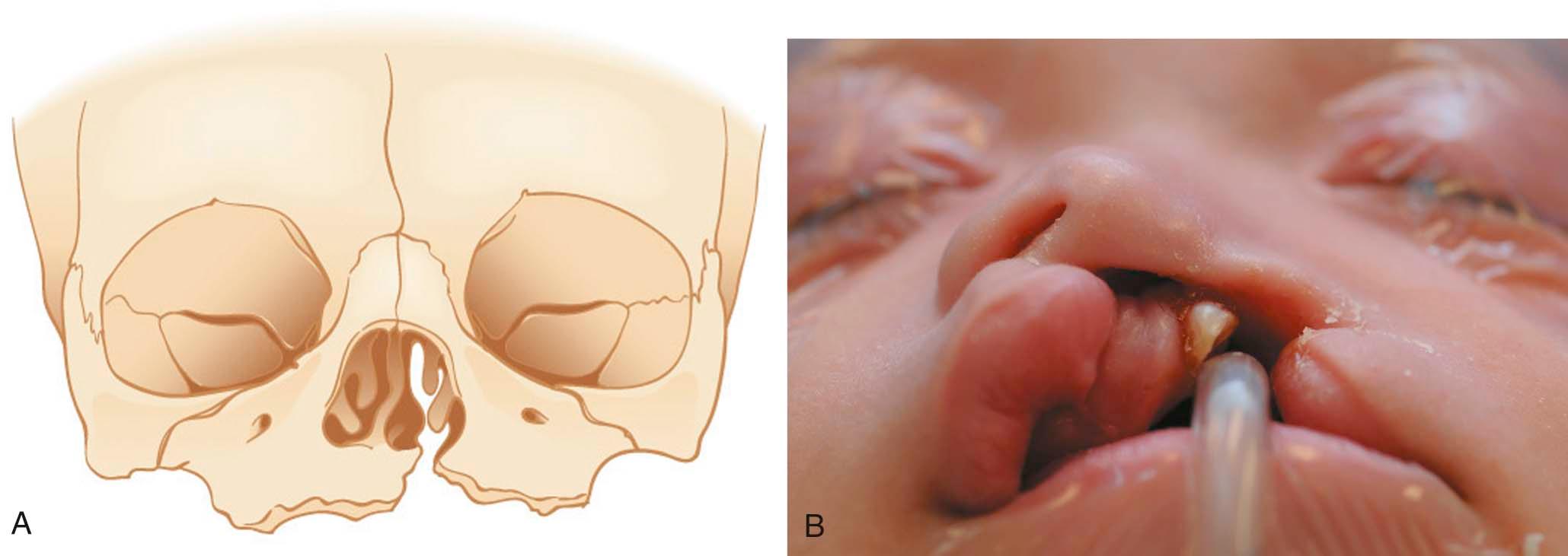 Figure 34-3, A, Schematic diagram of a left cleft nasal deformity showing the architecture of the caudal septum deviated to the noncleft side. B, Intraoperative photograph of this complete cleft lip and nasal deformity.