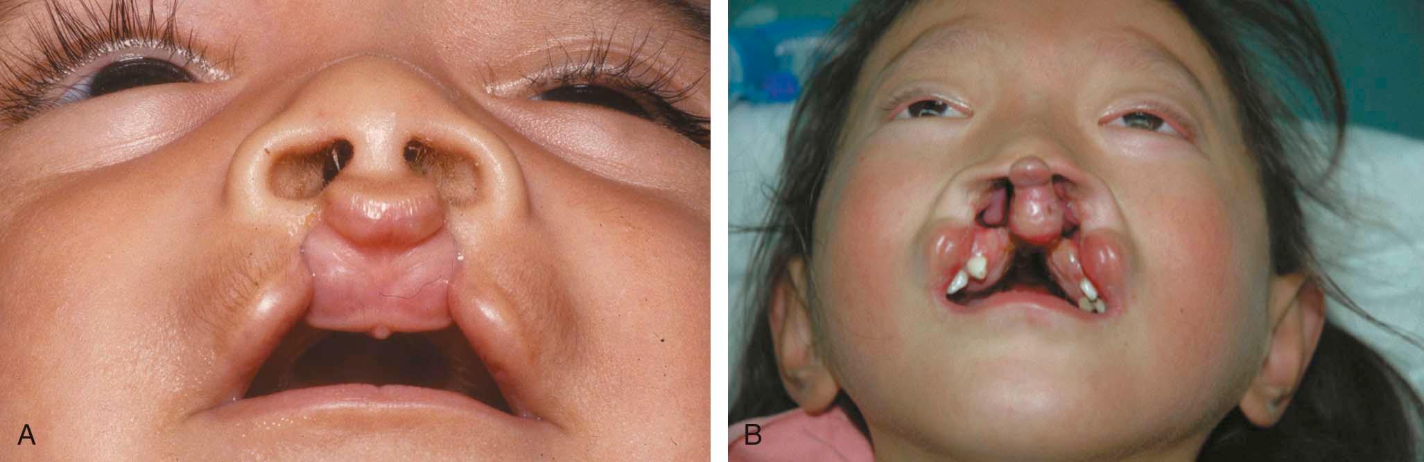 Figure 34-4, A, Basal view of a patient with incomplete bilateral cleft lip with good projection. B ,