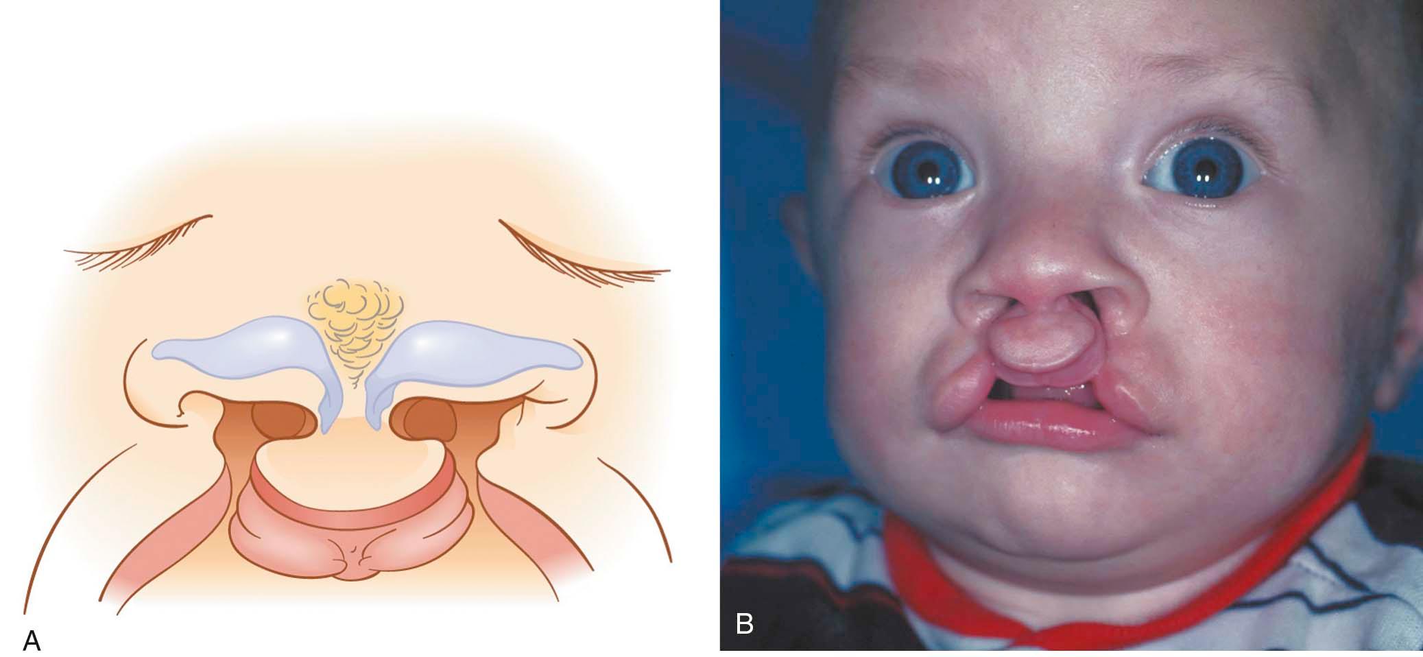Figure 34-5, A, B, Schematic diagram and photograph of a patient with bilateral complete cleft lip deformity. The medial crus of each side of the nose is shorter and the lateral crus longer than in unaffected alar cartilage.