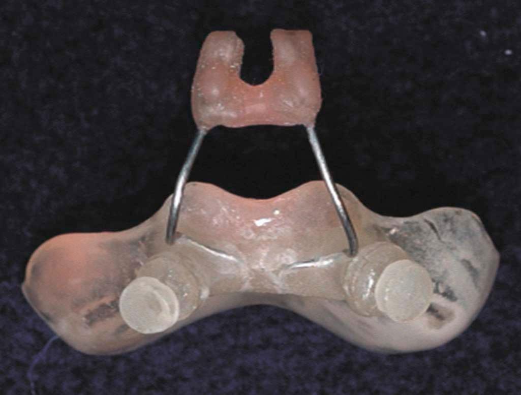 Figure 34-6, Photograph of a presurgical nasoalveolar molding device (PNAM).
