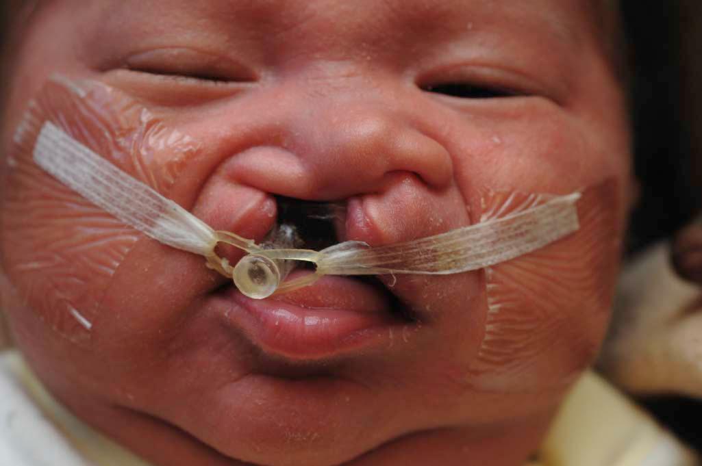 Figure 34-7, Patient with complete unilateral cleft lip and palate with the PNAM device in place.