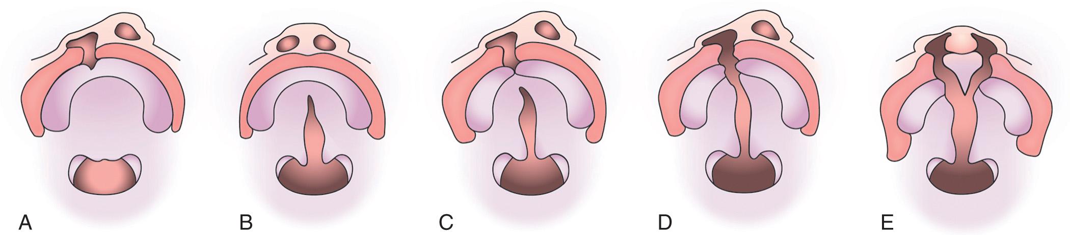 Fig. 336.1, Nonsyndromic orofacial clefts.